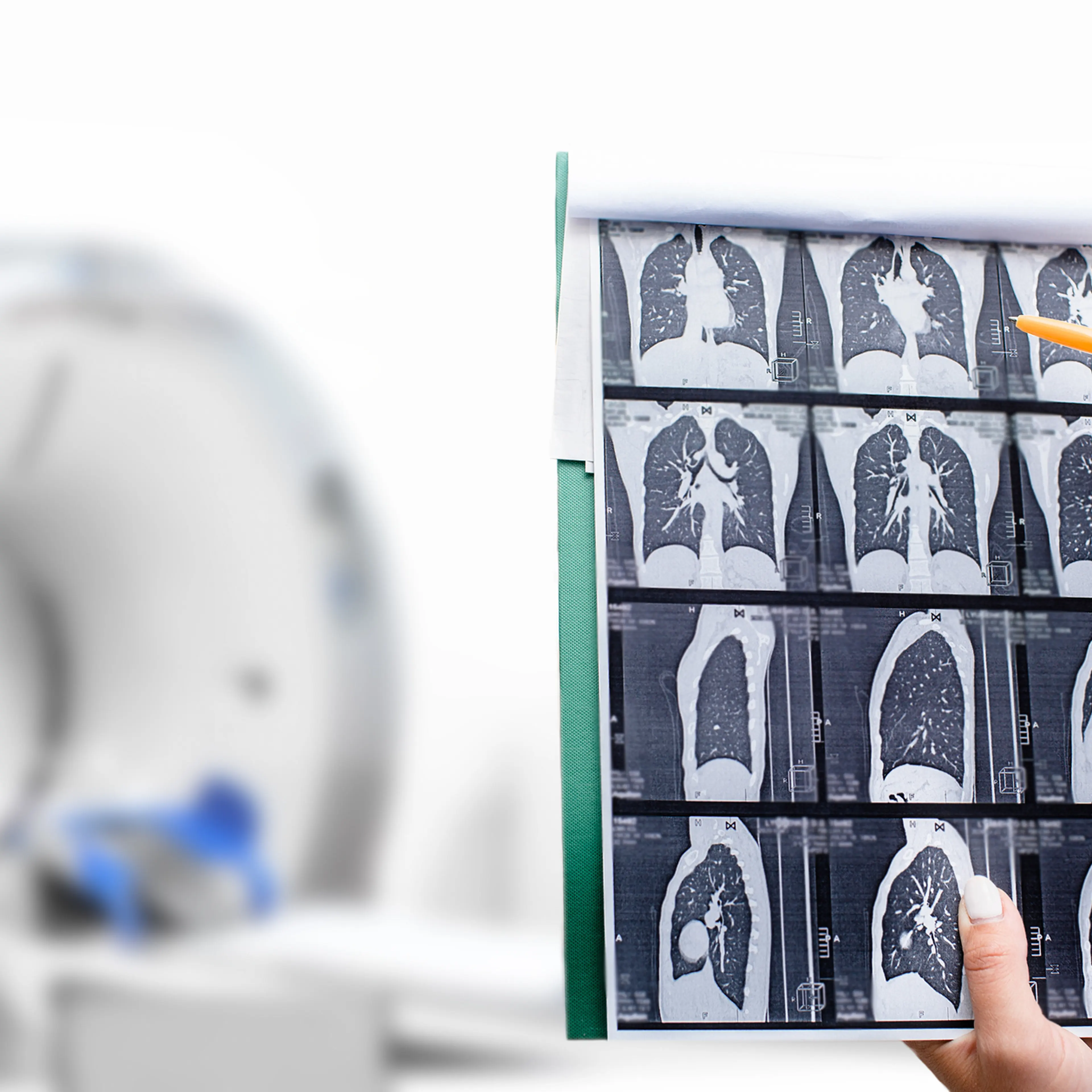 lung cancer