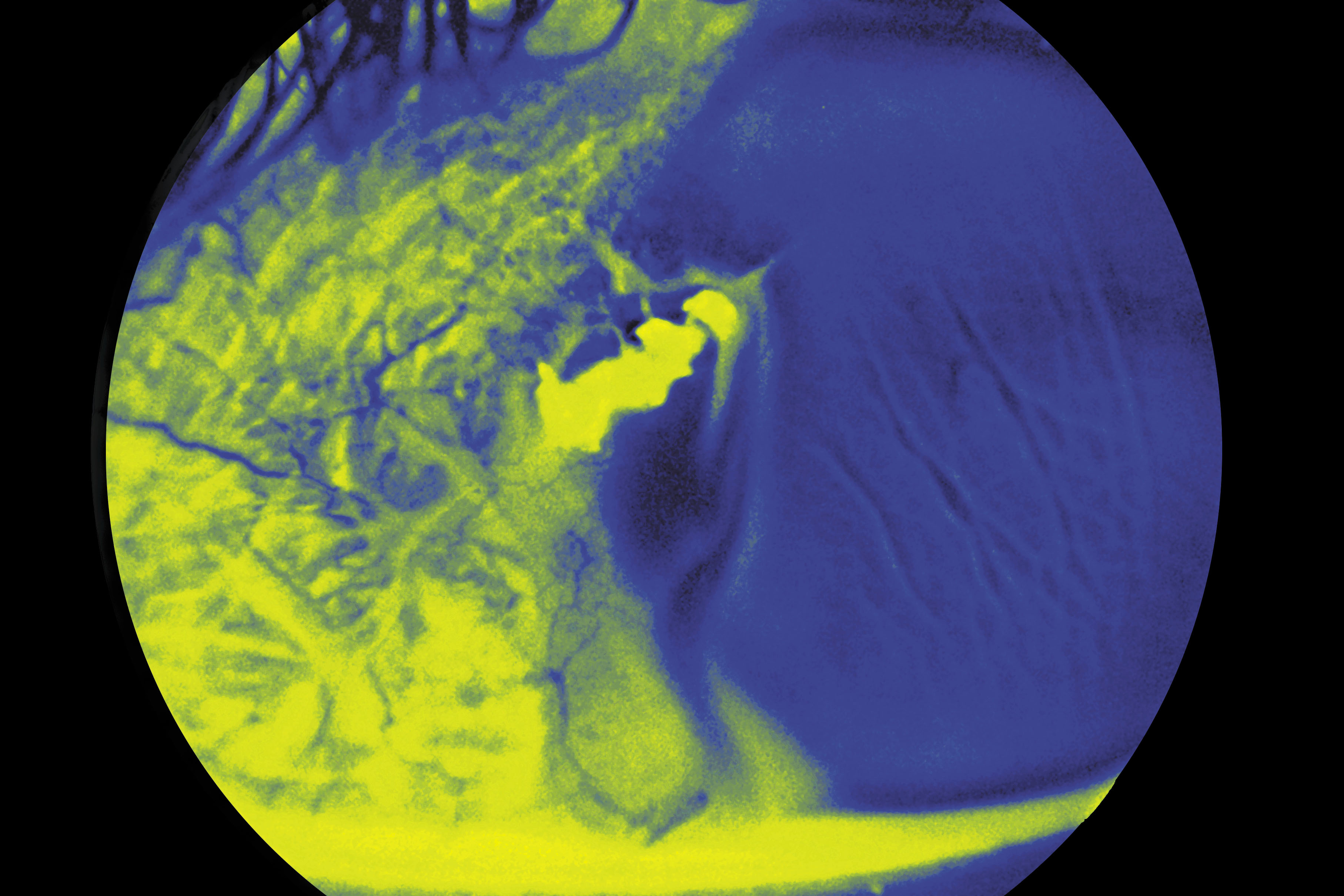 Injured Cornea