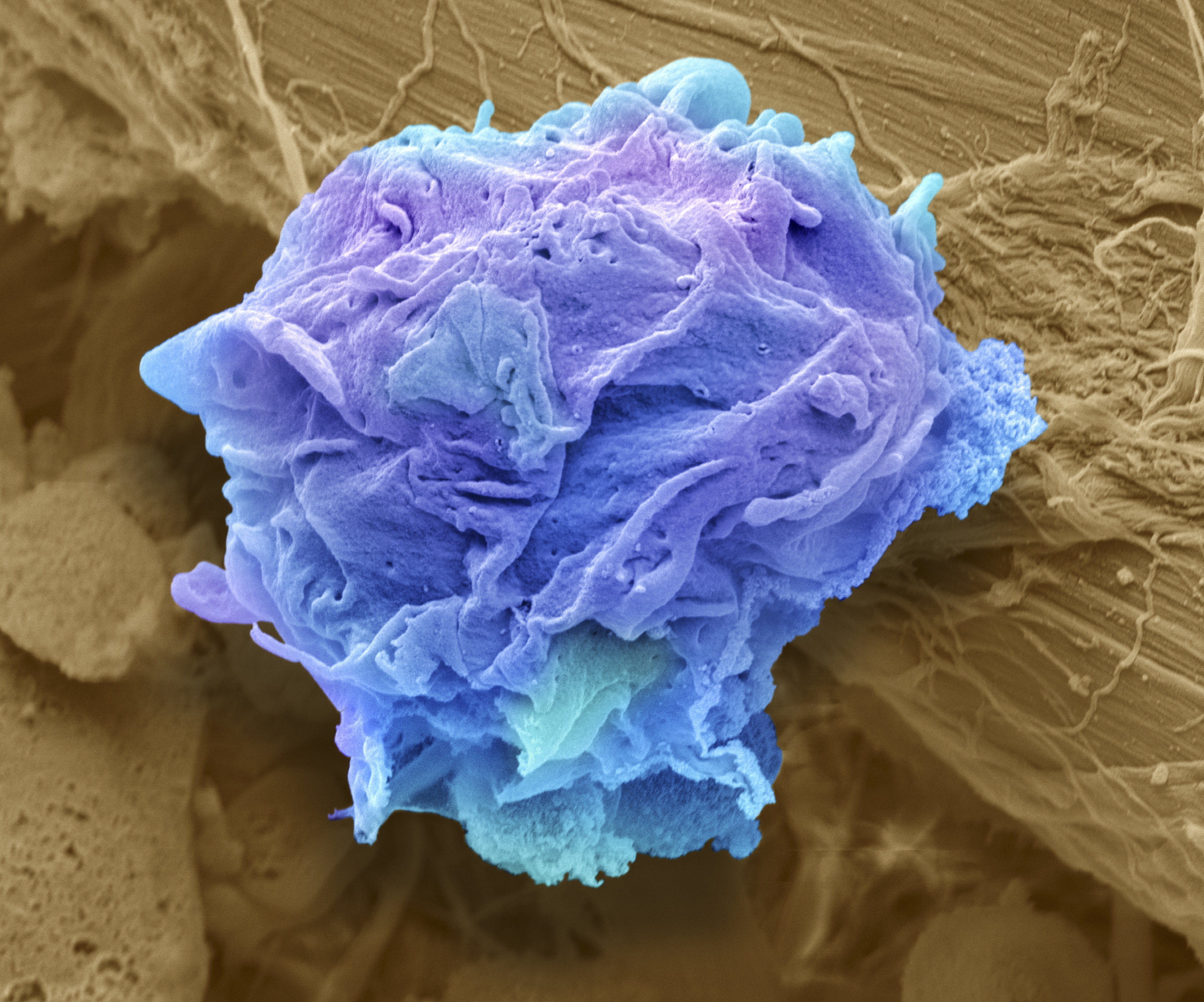 Lymphoma cancer cell. Coloured scanning electron micrograph (SEM) of a lymphoma cell. A lymphoma is a cell of the immune system that has become cancerous. The cell becomes immortal and can grow indefinitely. A number of these cells will form a tumour. Ly