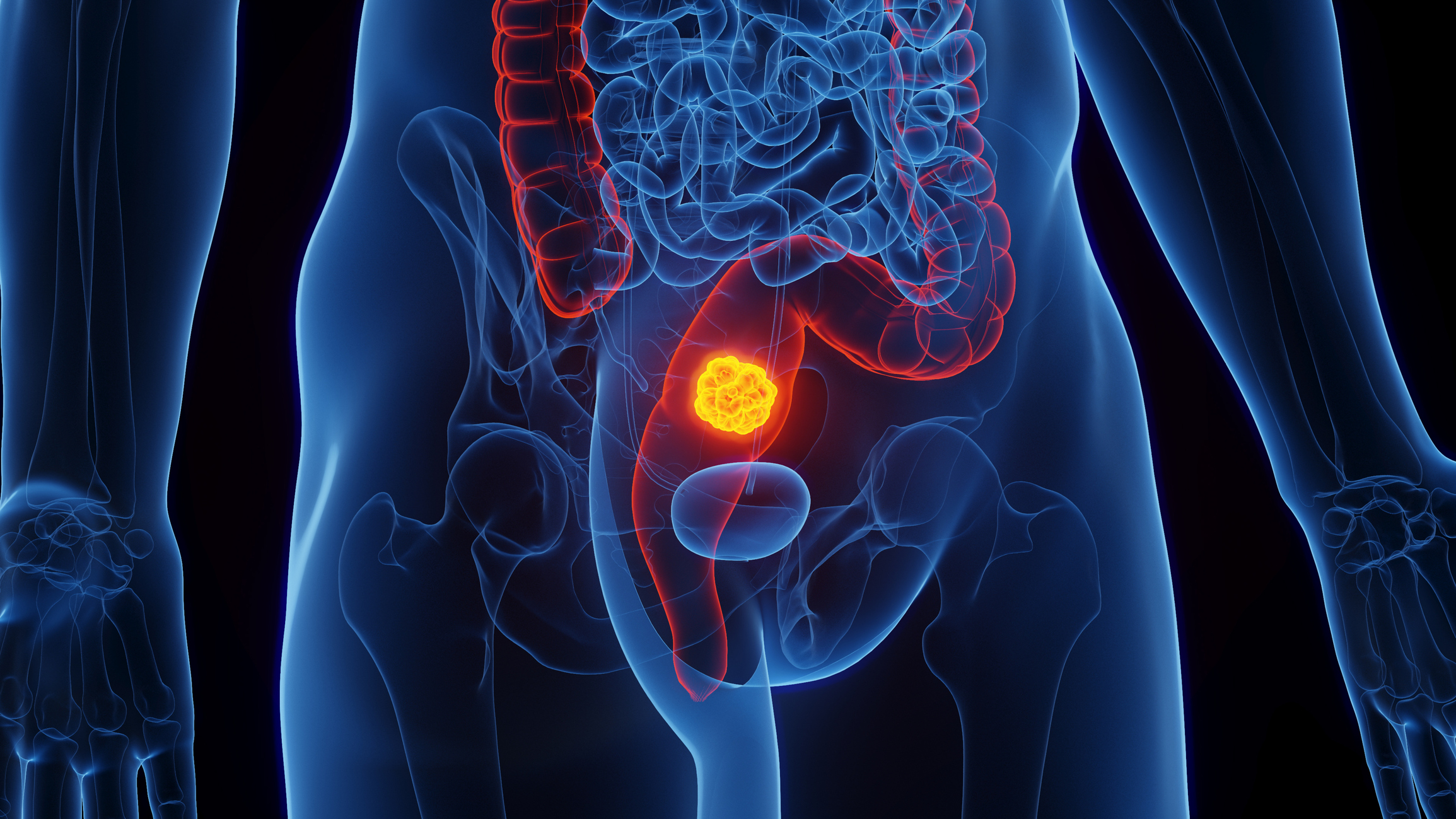 Some Rectal Cancer Patients May Be Able to Skip Surgery, Chemo, and Radiation