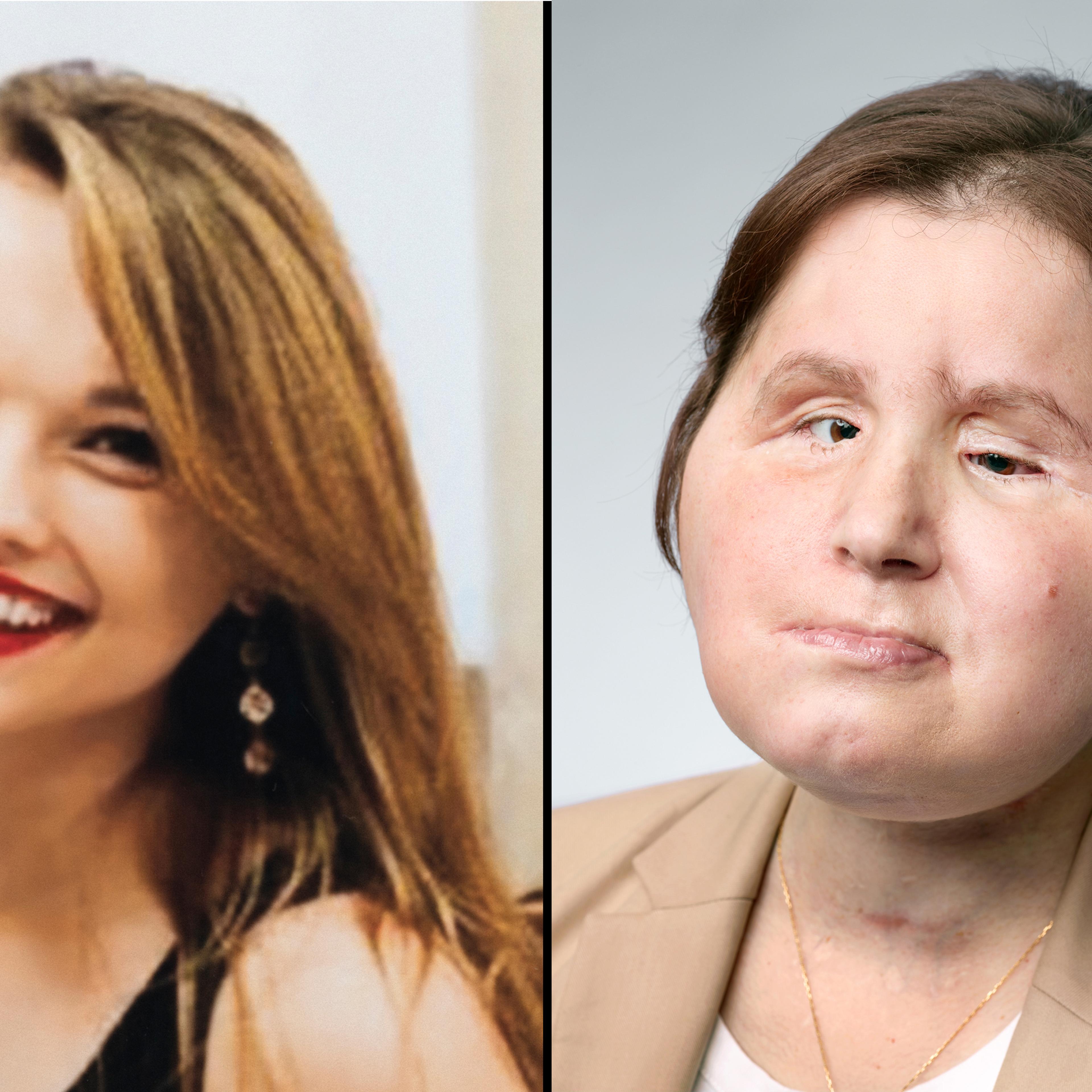 Left: Katie Stubblefield, 17, 8 months before attempting suicide. Right: Katie, 22, one year and one month after her surgery. At 21, Katie became the youngest person in the United States to have a face transplant. She is the 40th person in the world know