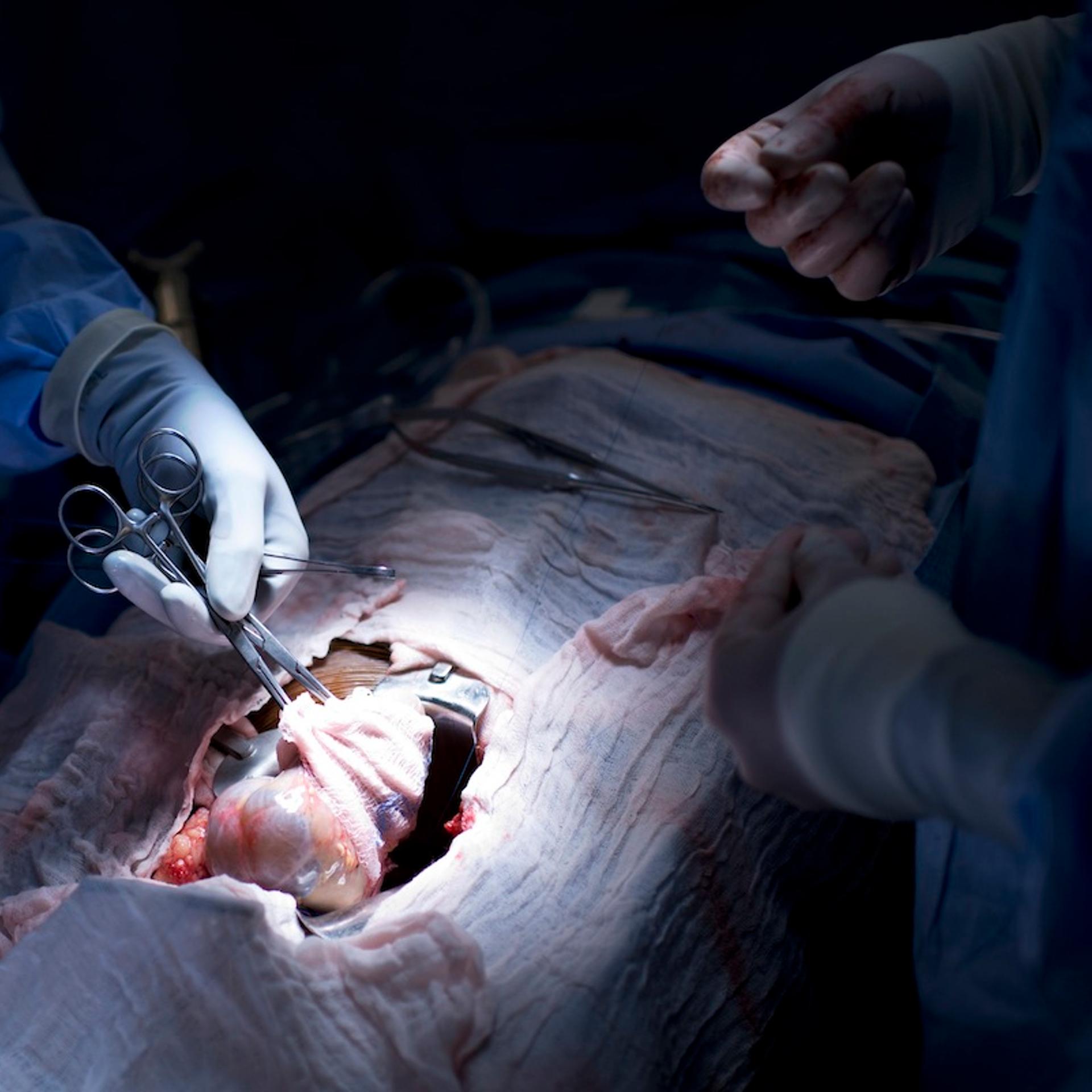 Dr. Niraj Desai (L) places a kidney into