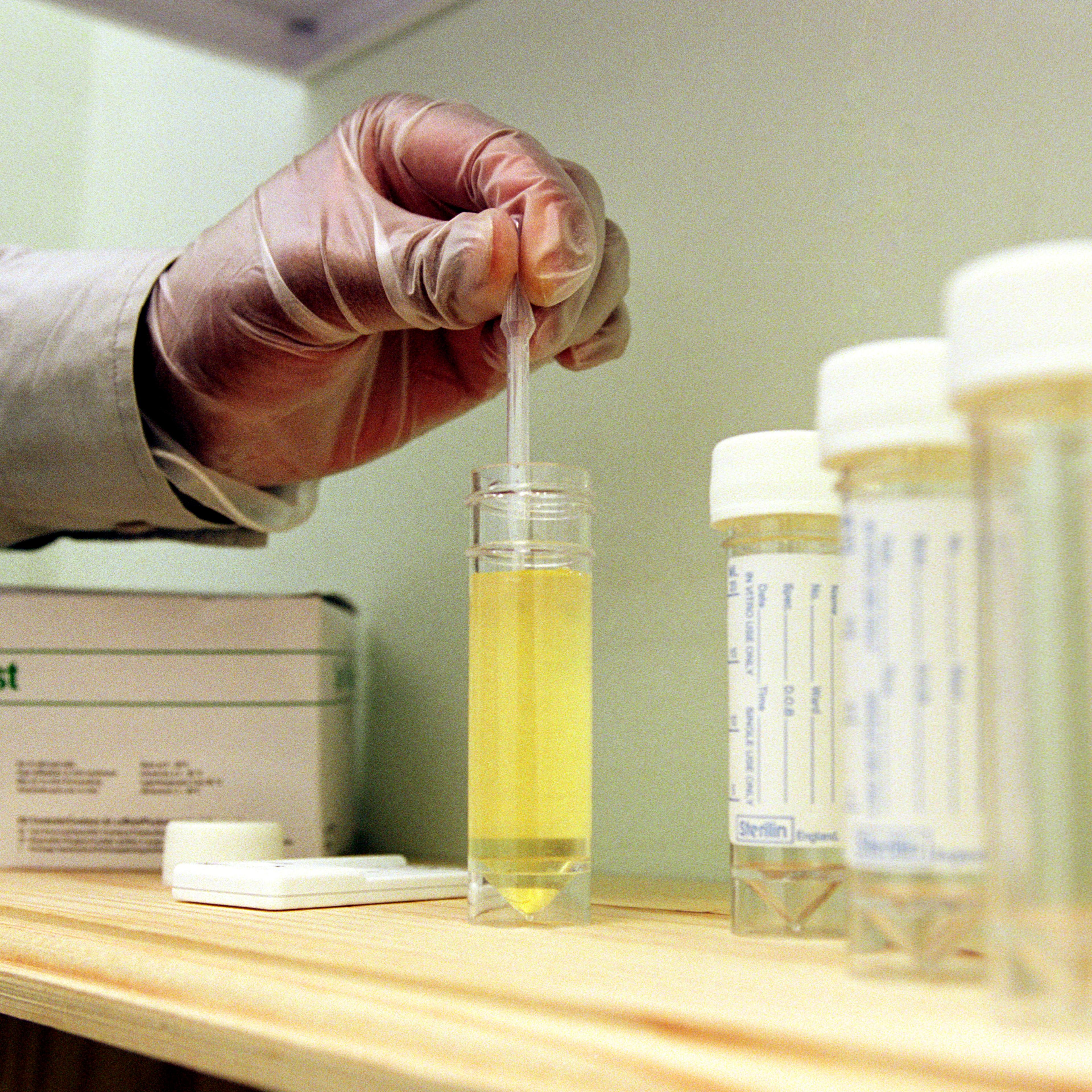 Drug counsellor testing urine for traces of drugs.