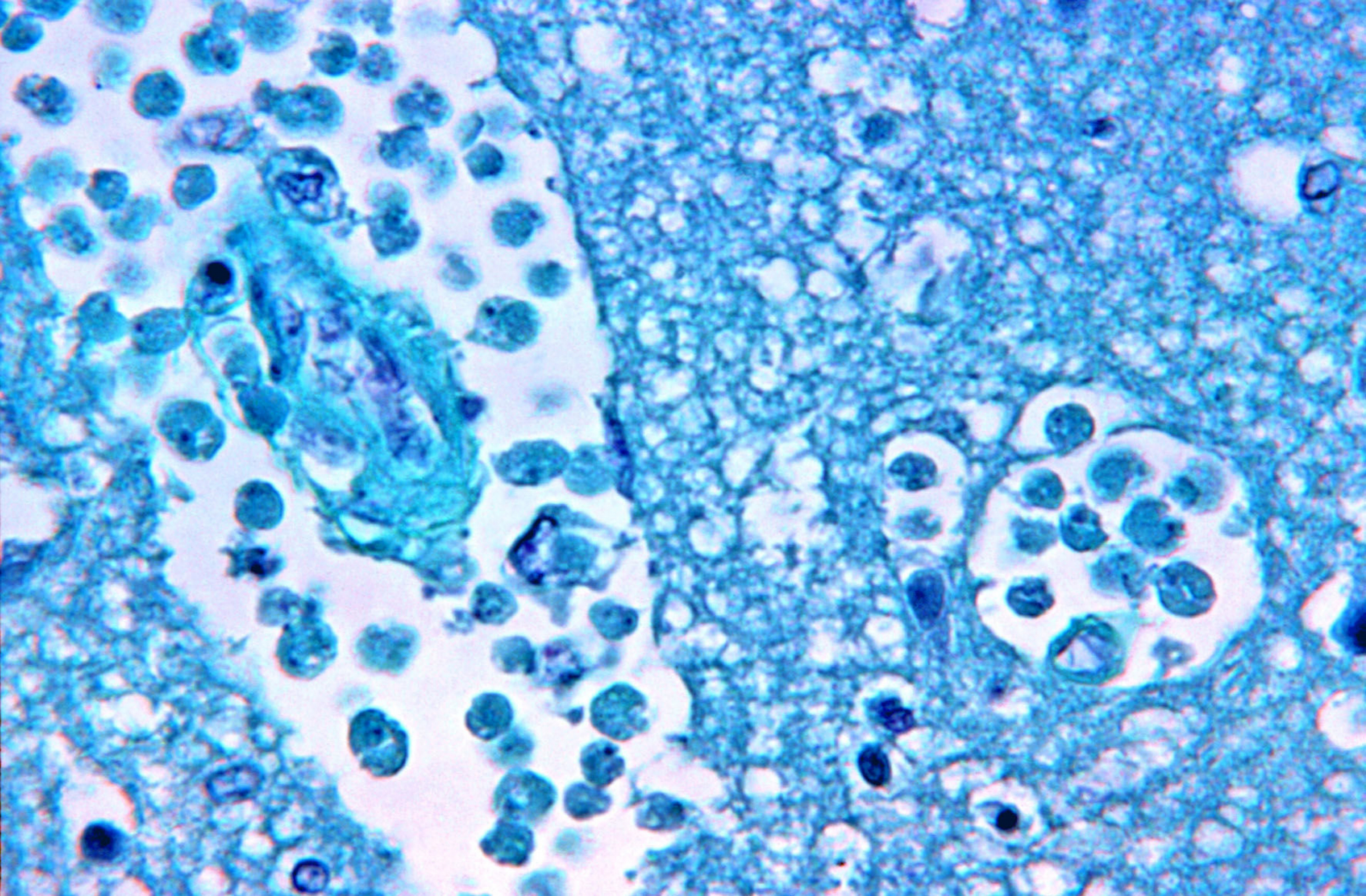 Brain Histology Naegleria Fowleri