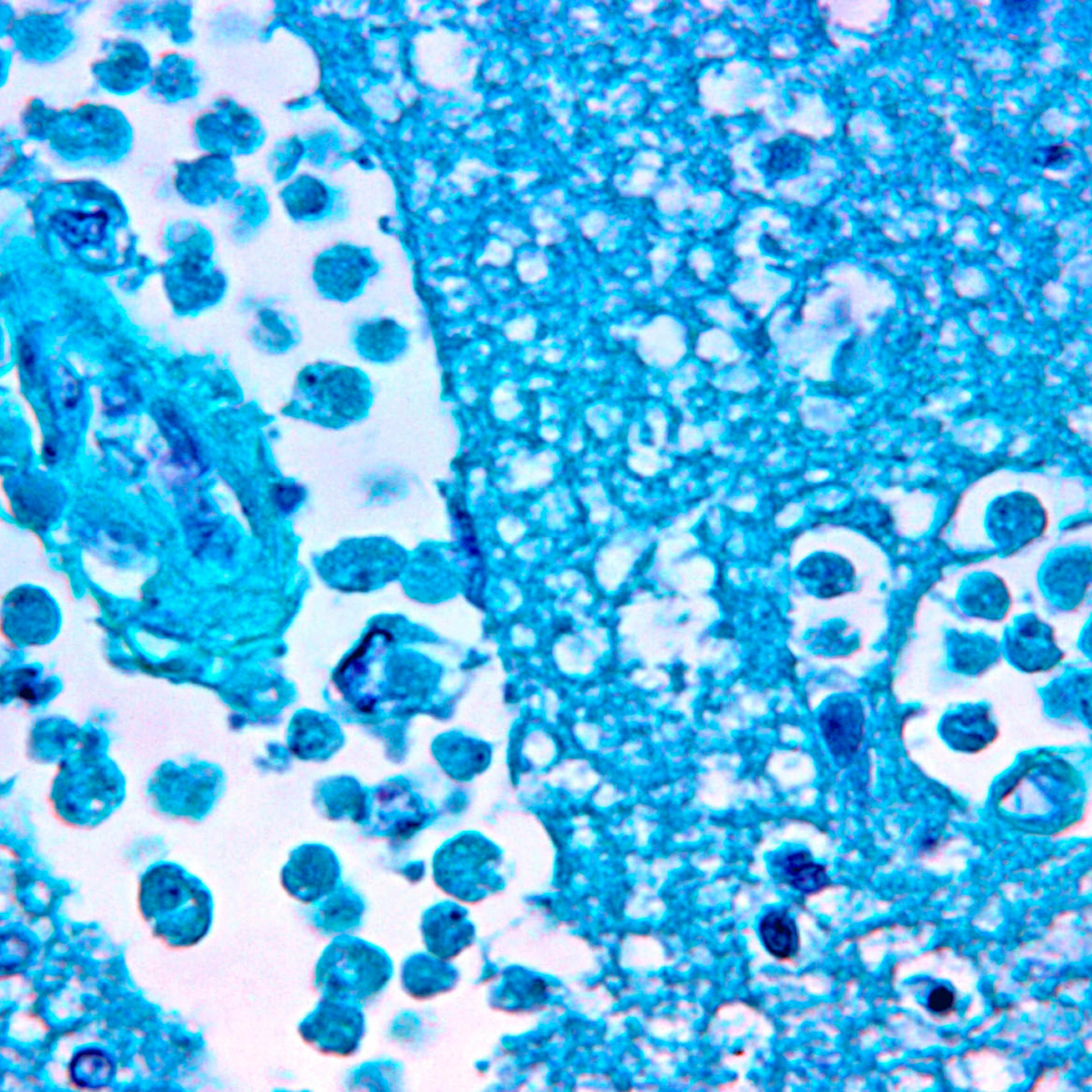 Brain Histology Naegleria Fowleri