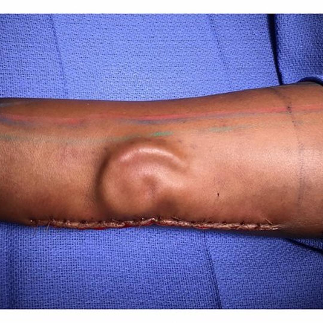 army-ear-reconstruction