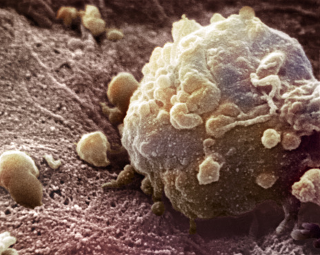 Melanoma Cell