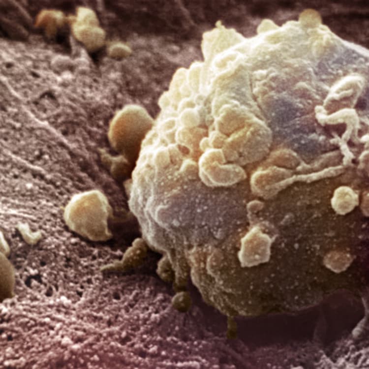 Melanoma Cell