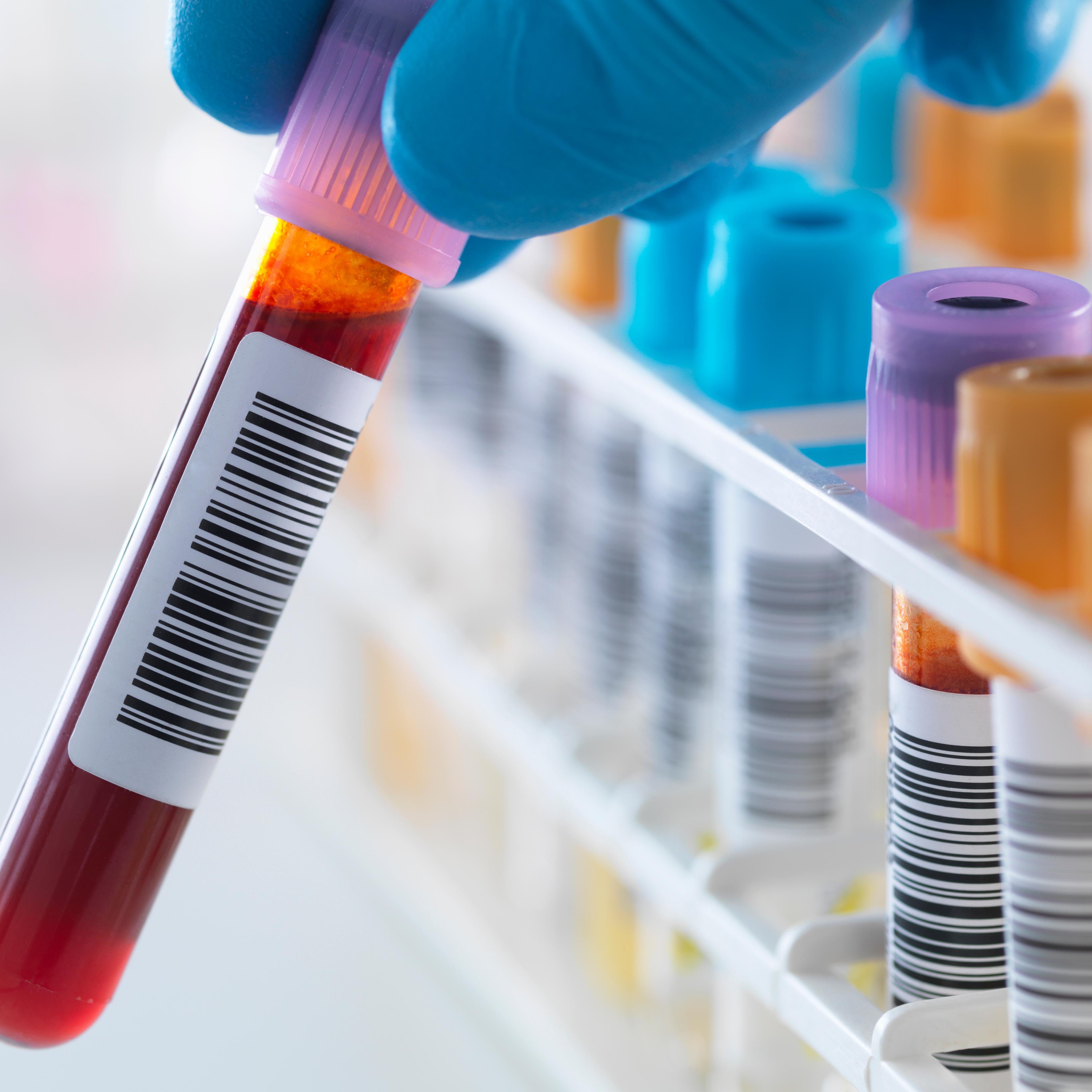 A blood sample being held with a row of human samples for analytical testing including blood, urine, chemistry, proteins, anticoagulants and HIV in lab