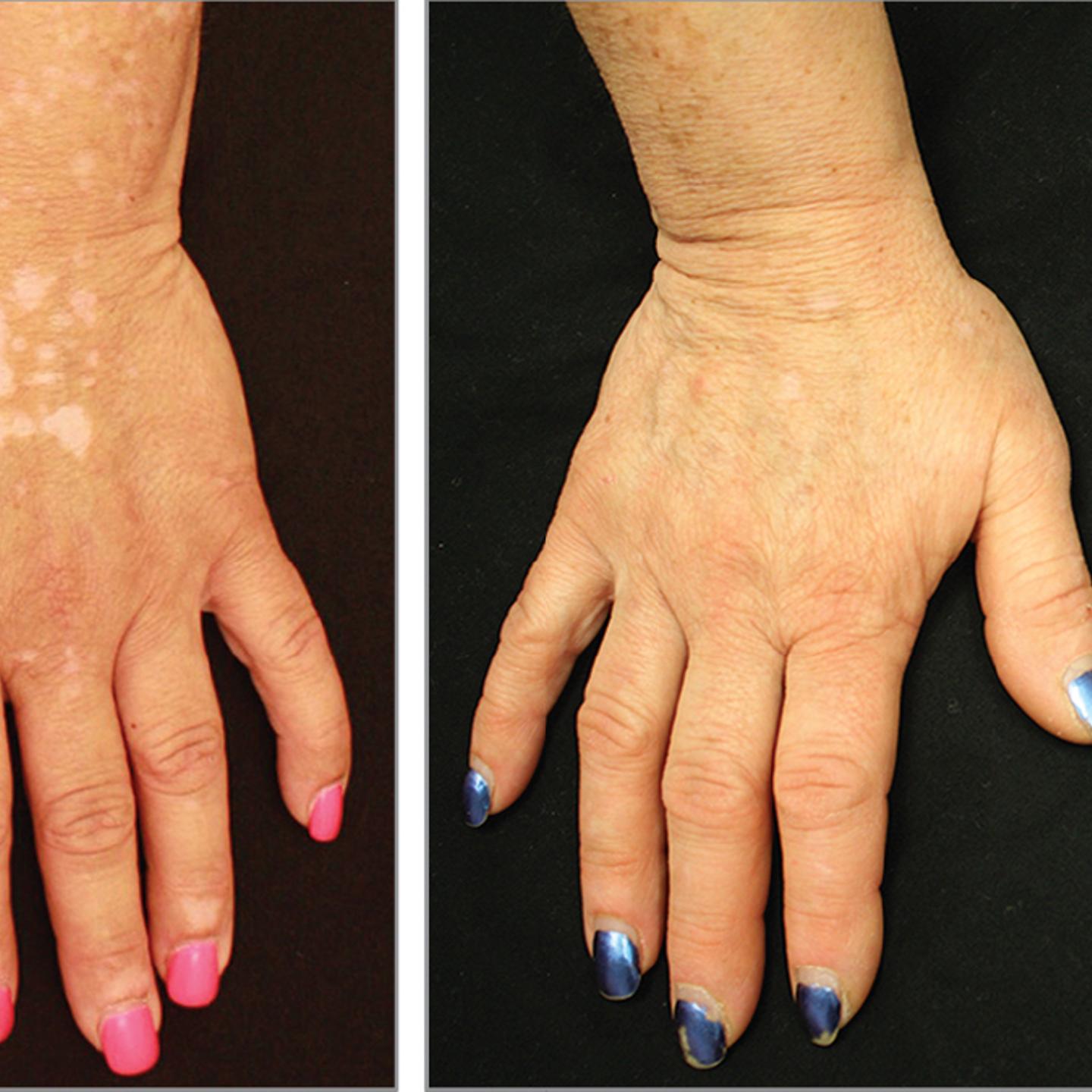 skin pigmentation arthritis
