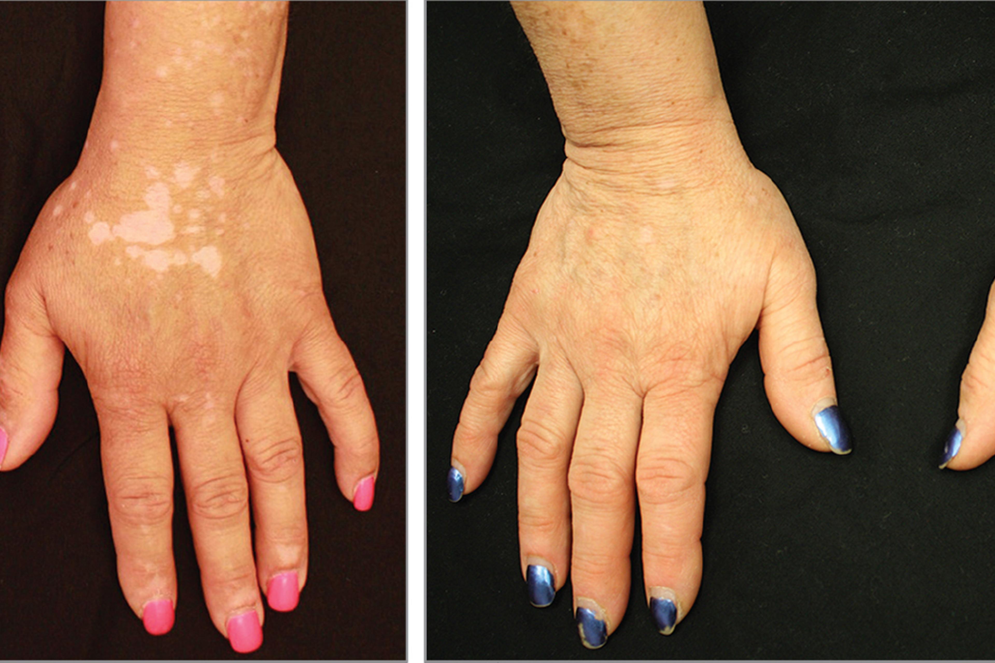 Vitiligo: Existing Drug Brought Pigment Back to Patient