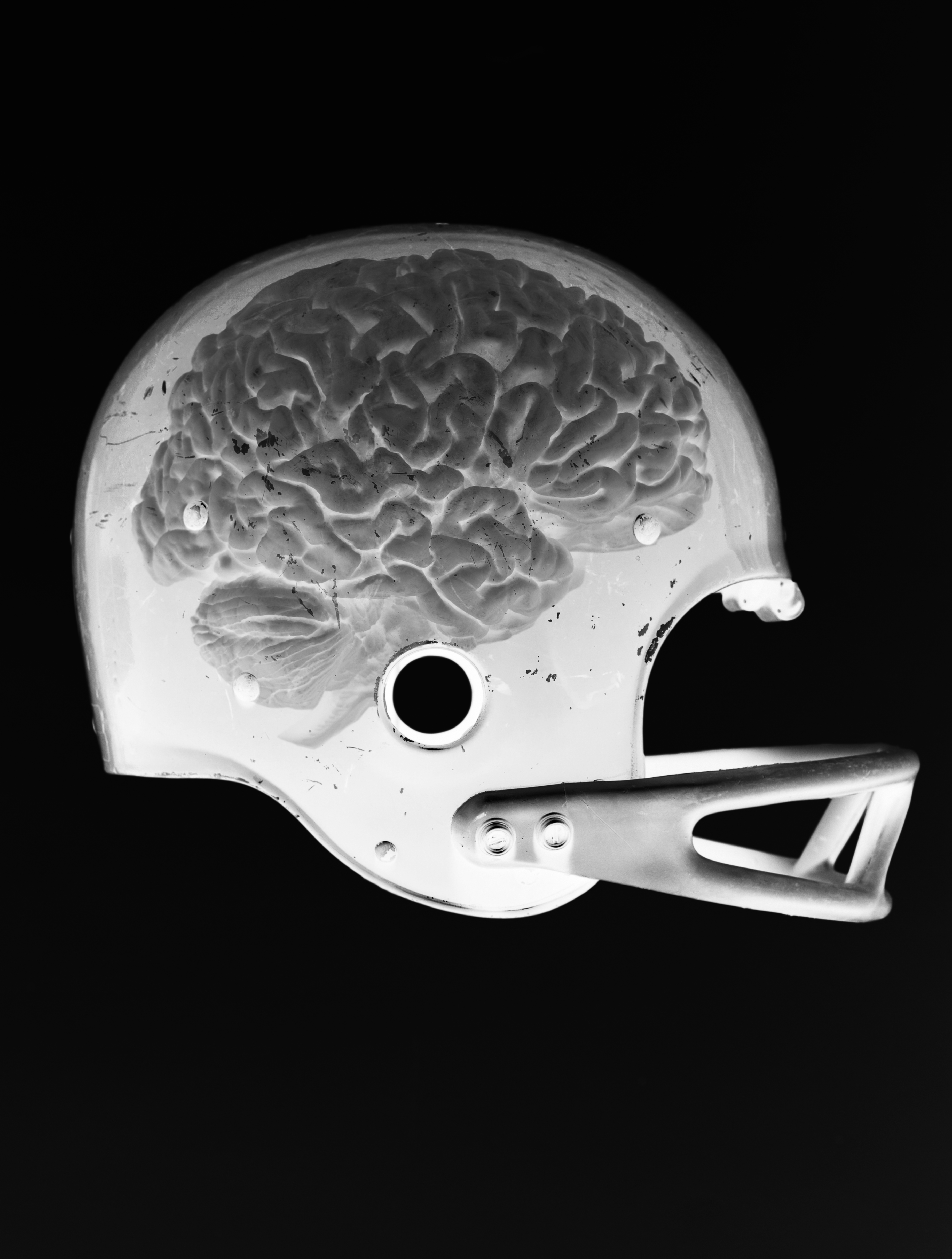 X-Ray image of a brain in a football helmet.