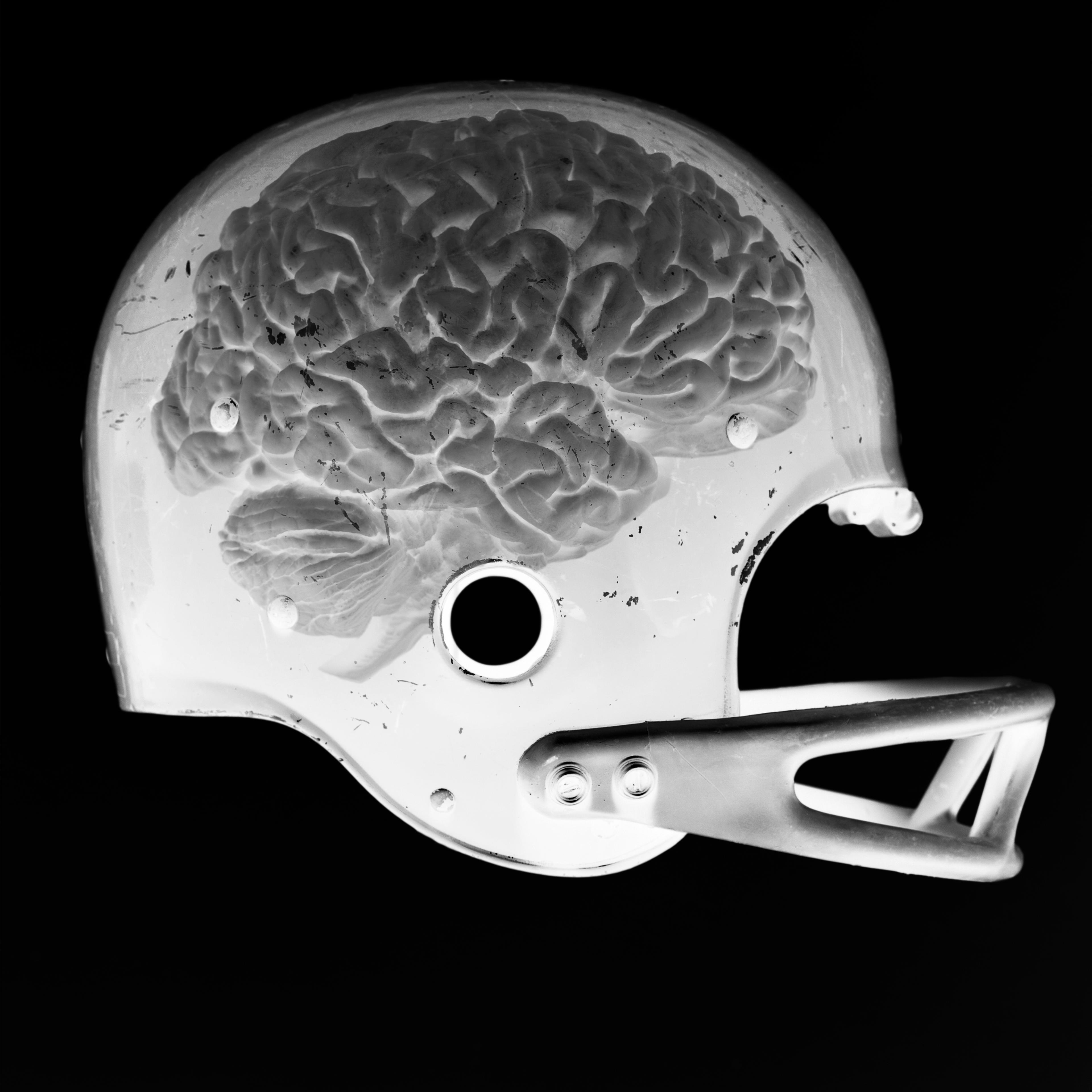 X-Ray image of a brain in a football helmet.