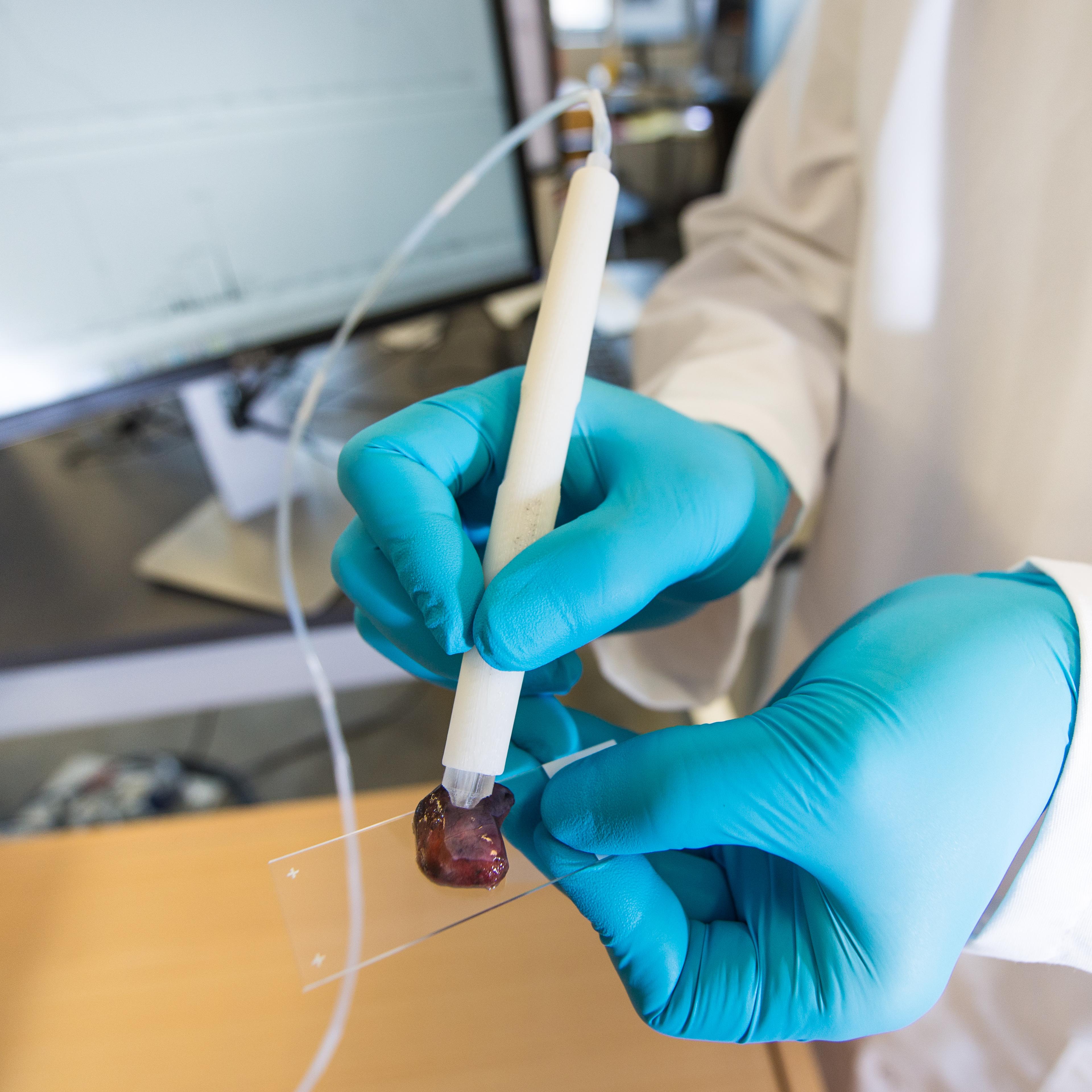 The MasSpec Pen is a handheld probe that can non-destructively analyze human tissue samples to identify cancer.