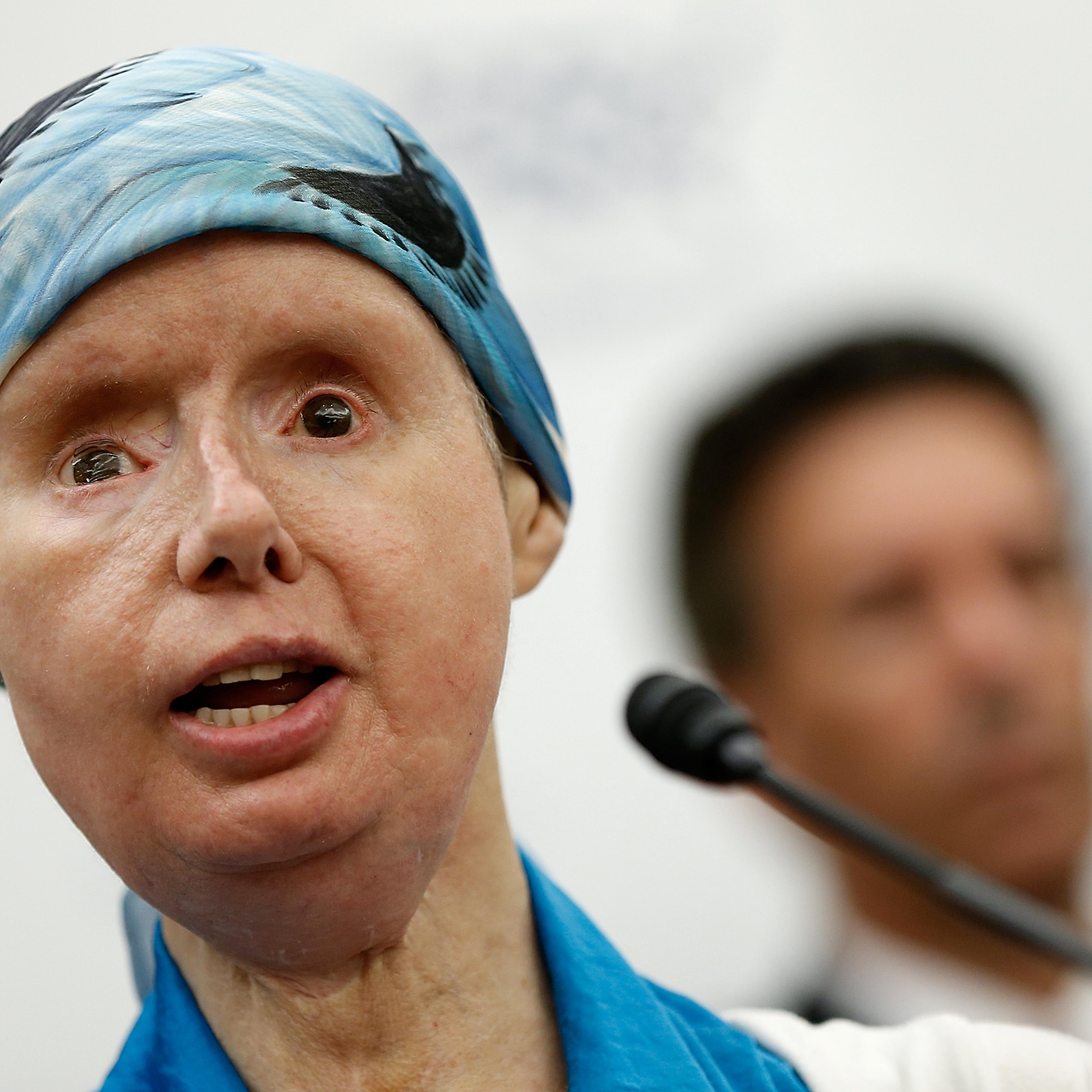Chimp Attack Victim Lobbies On Capitol Hill To Ban Trade Of Primates As Pets