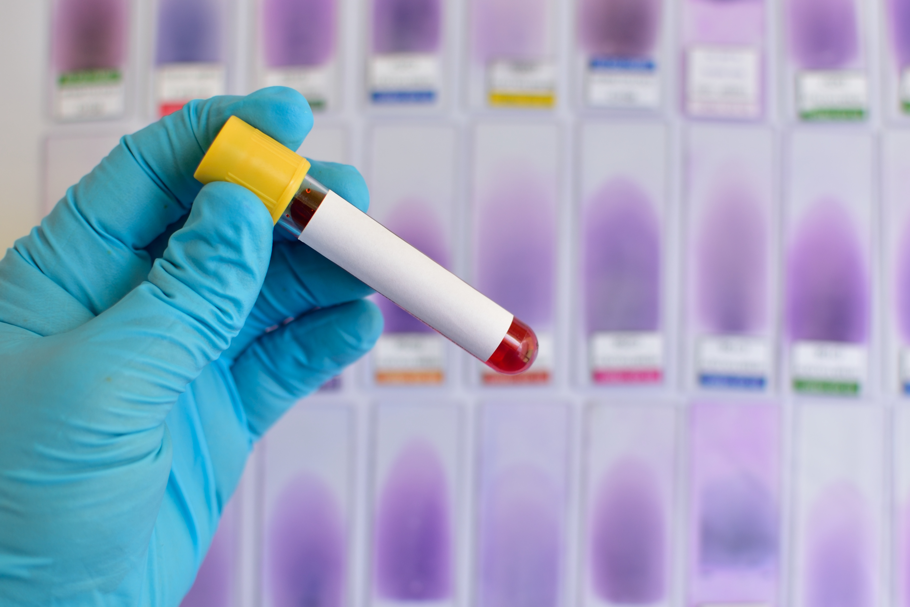 syphilis-blood-test