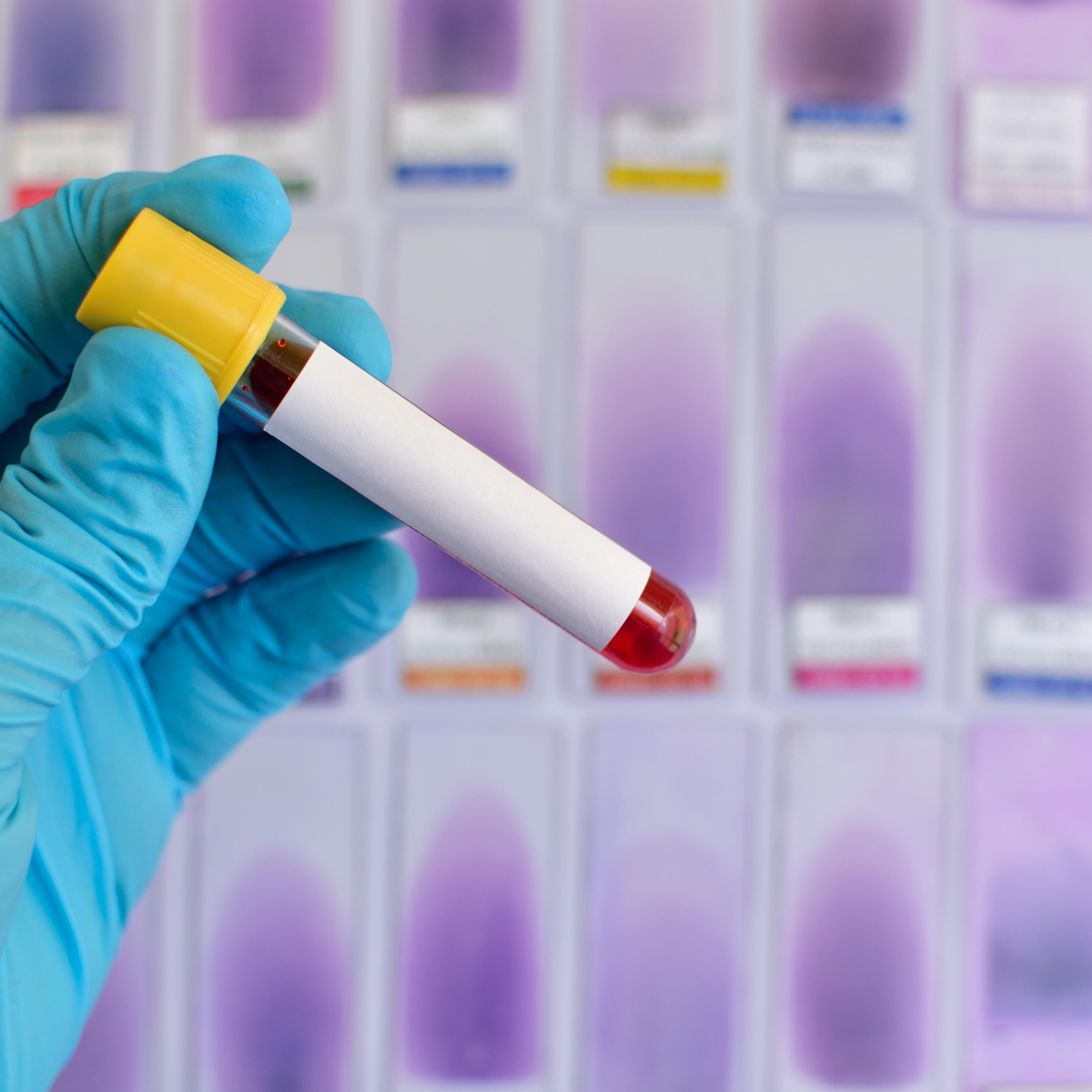 syphilis-blood-test