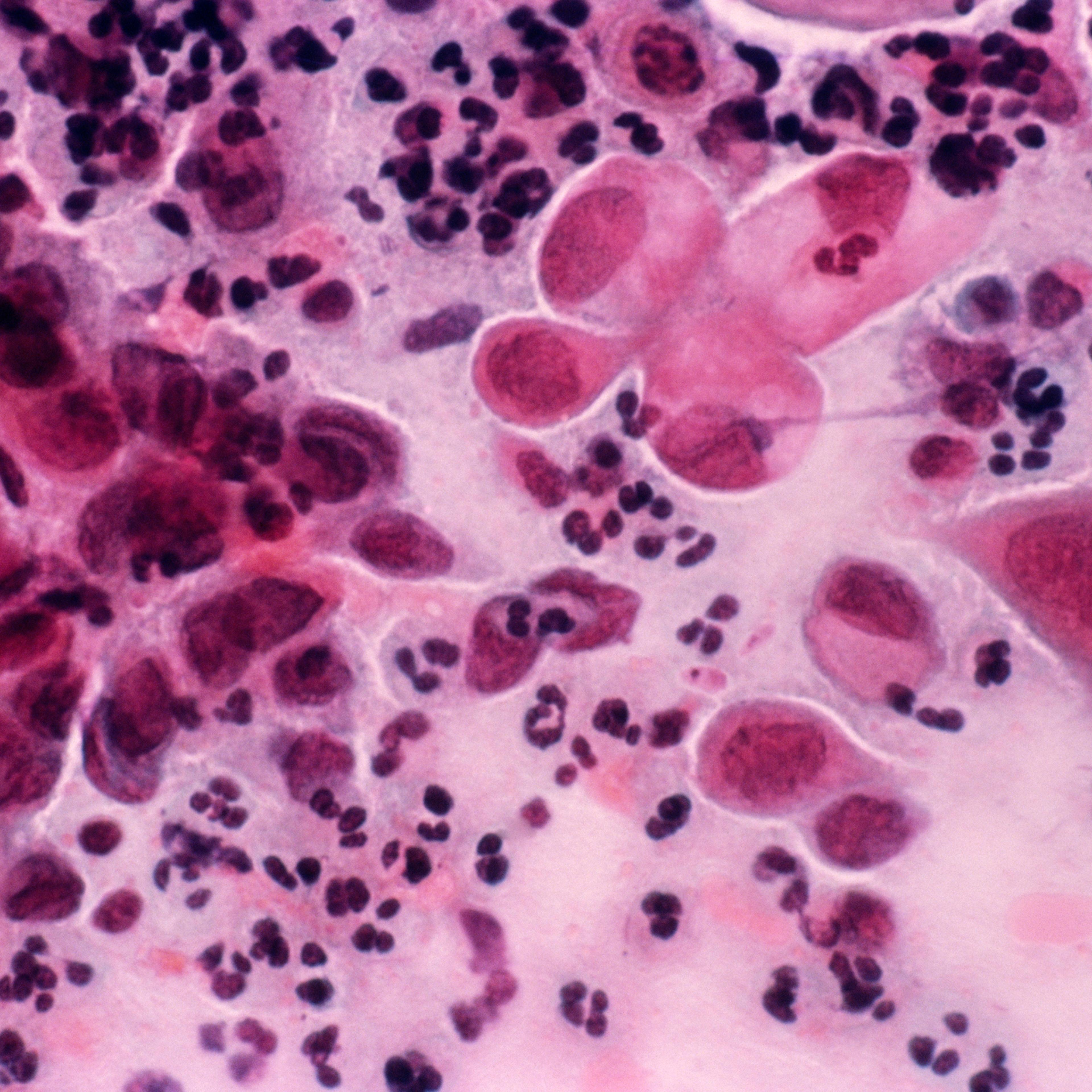 Light micrograph of a vaginal smear showing cancer cells (large pink cells with purple nuclei).