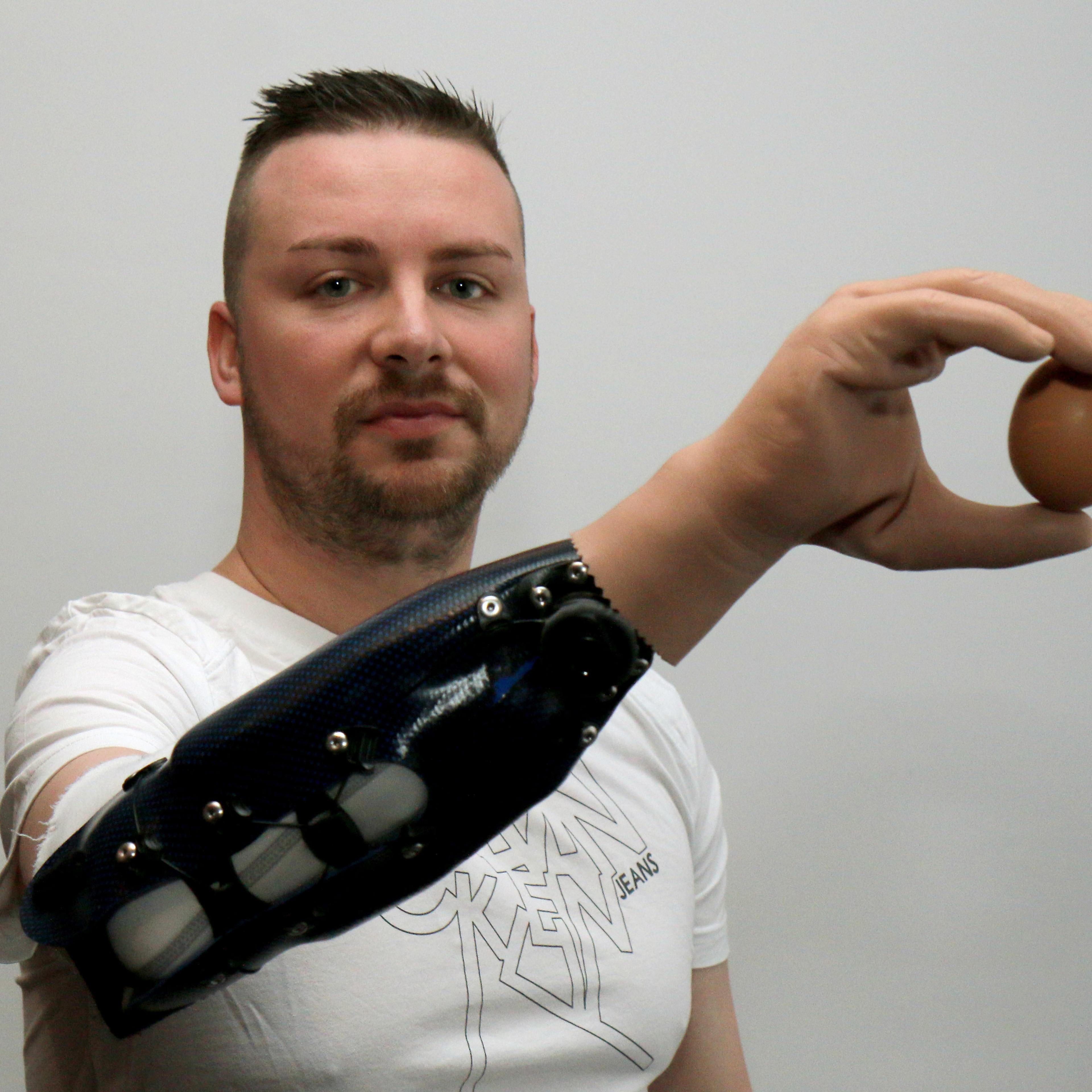 Milorad Marinkovic holds an egg with his bionic arm with his bionic arm in Vienna, Austria on Feb. 24, 2015.