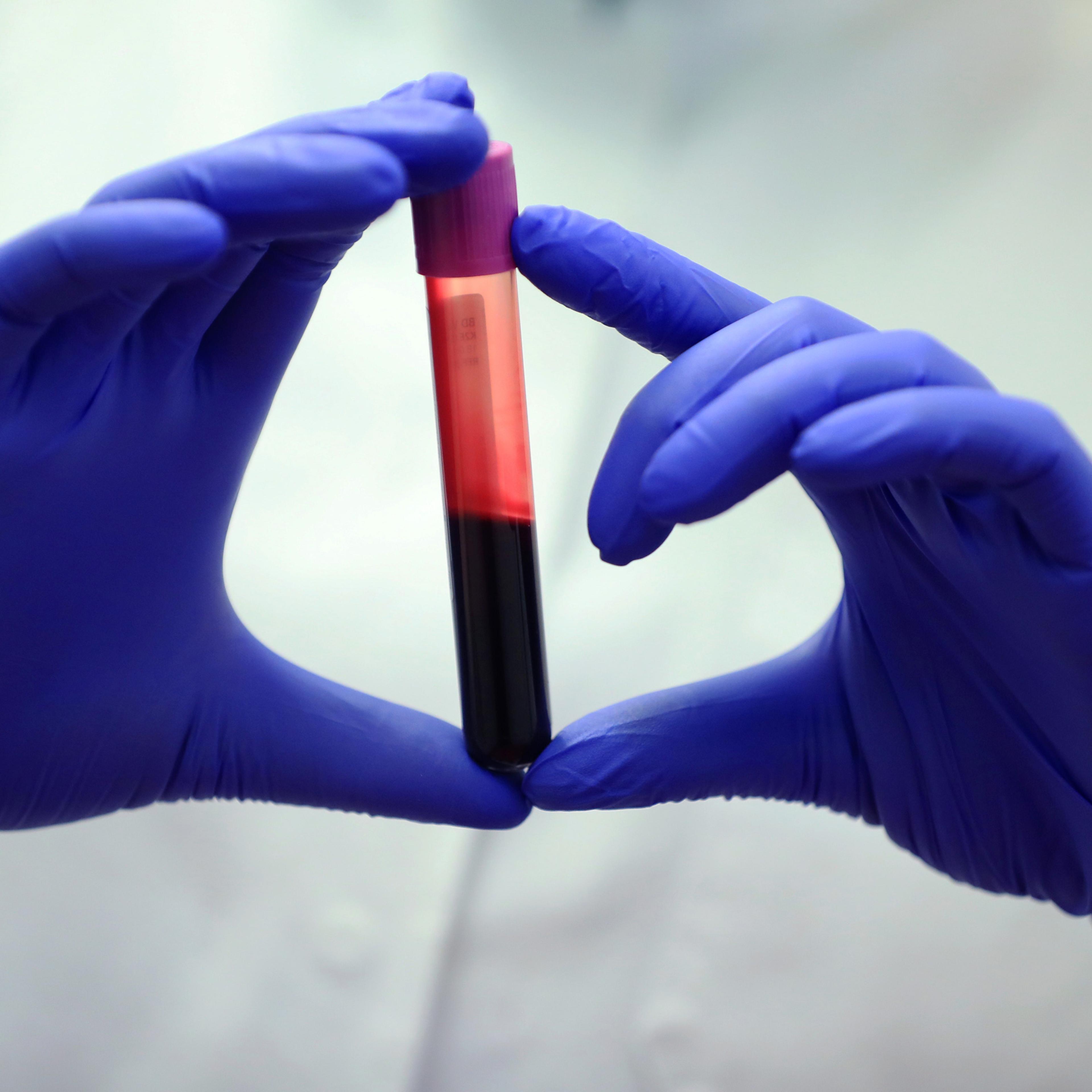 Blood Sample