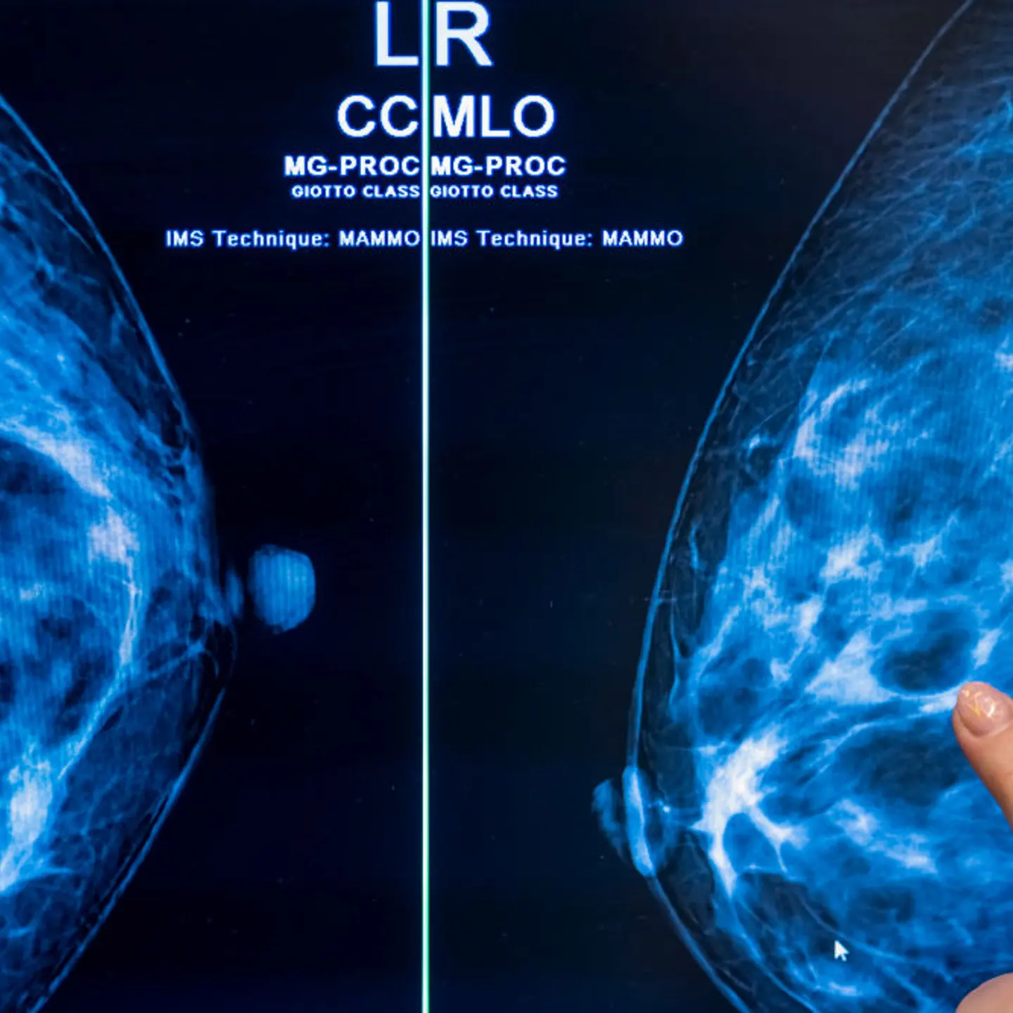 Mammography