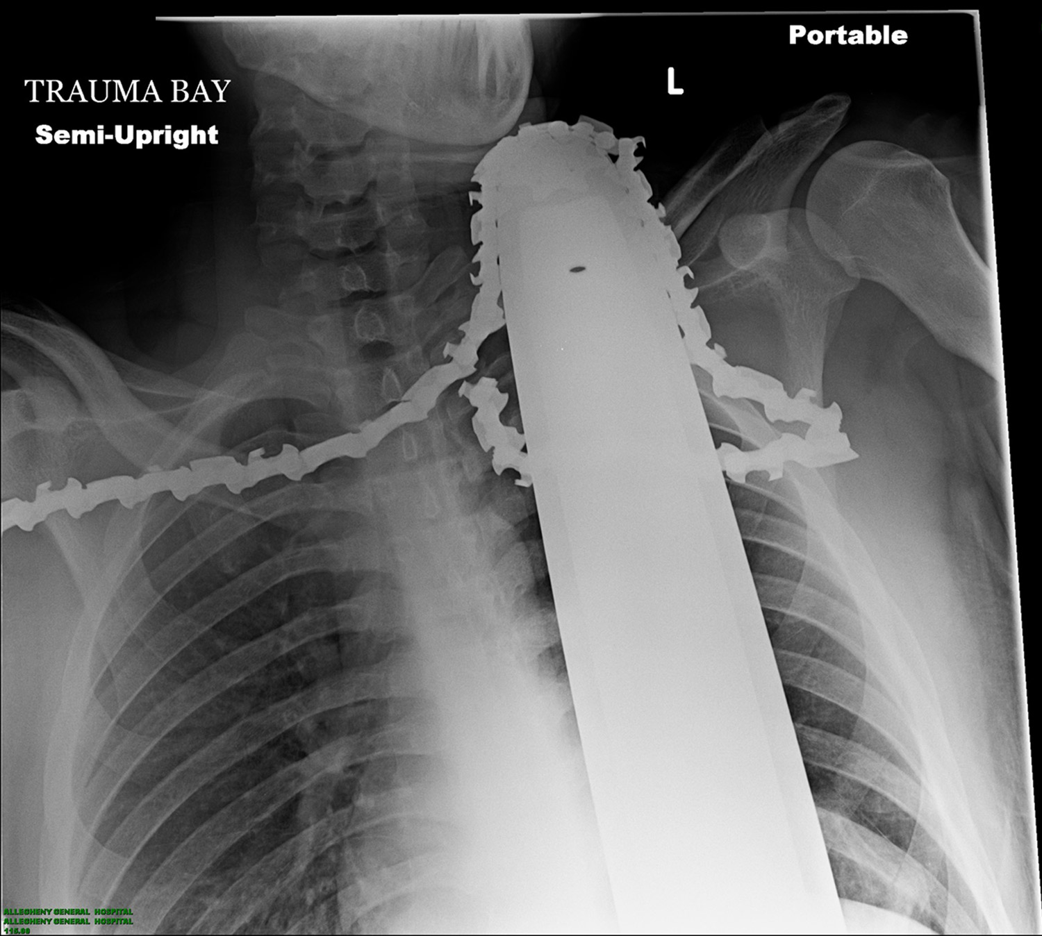 Chainsaw in Neck of Tree Trimmer Xray Allegheny Pennsylvania