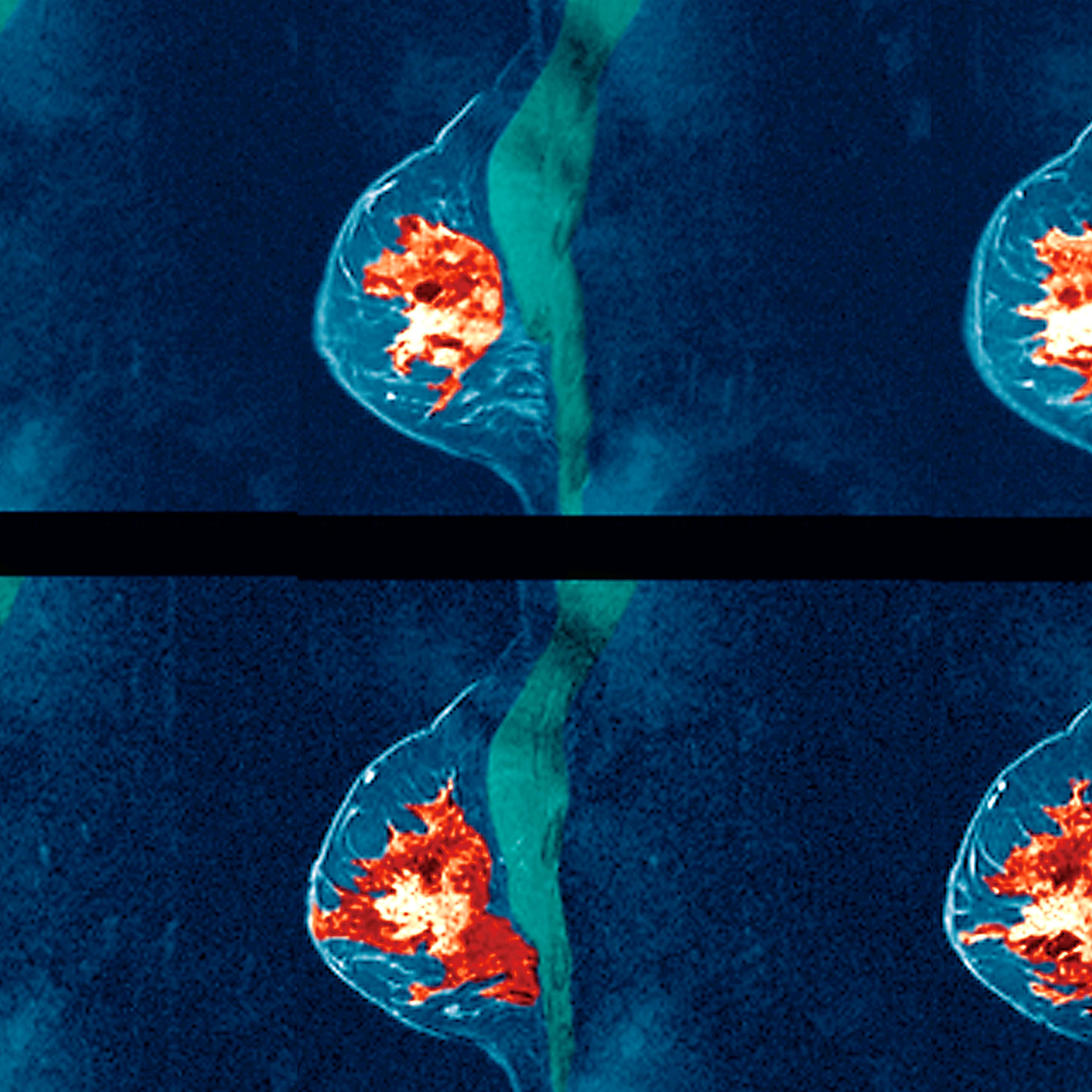 Breast cancer MRI scan