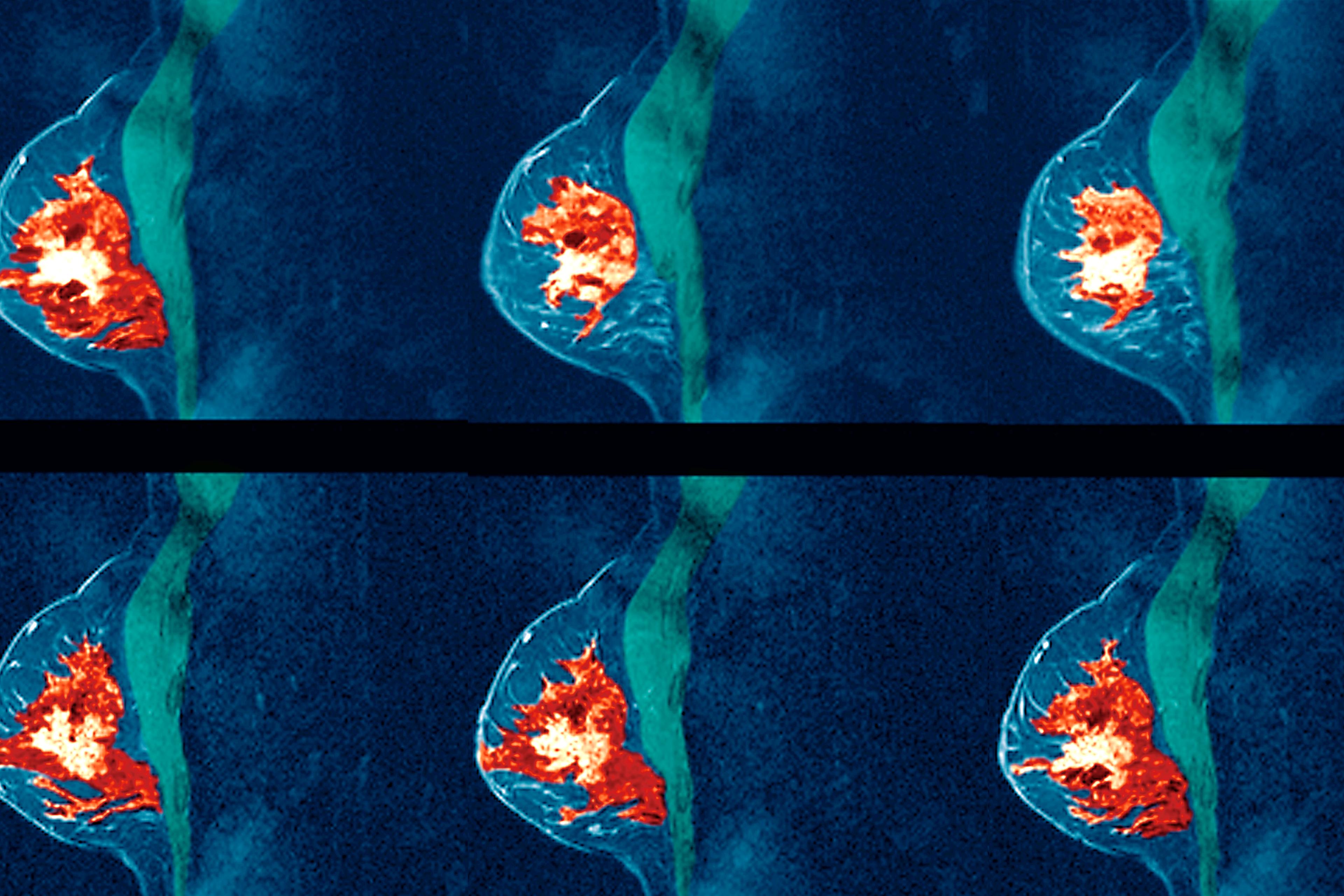 Breast cancer MRI scan