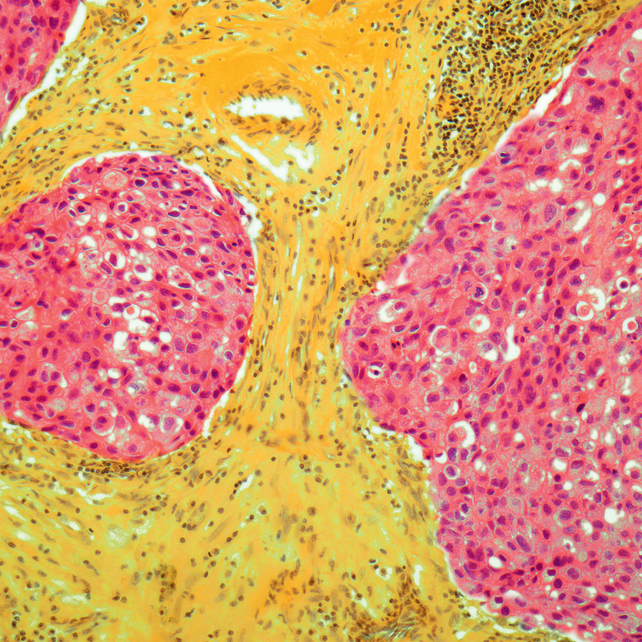 <b>Breast cancer</b> (light micrograph)