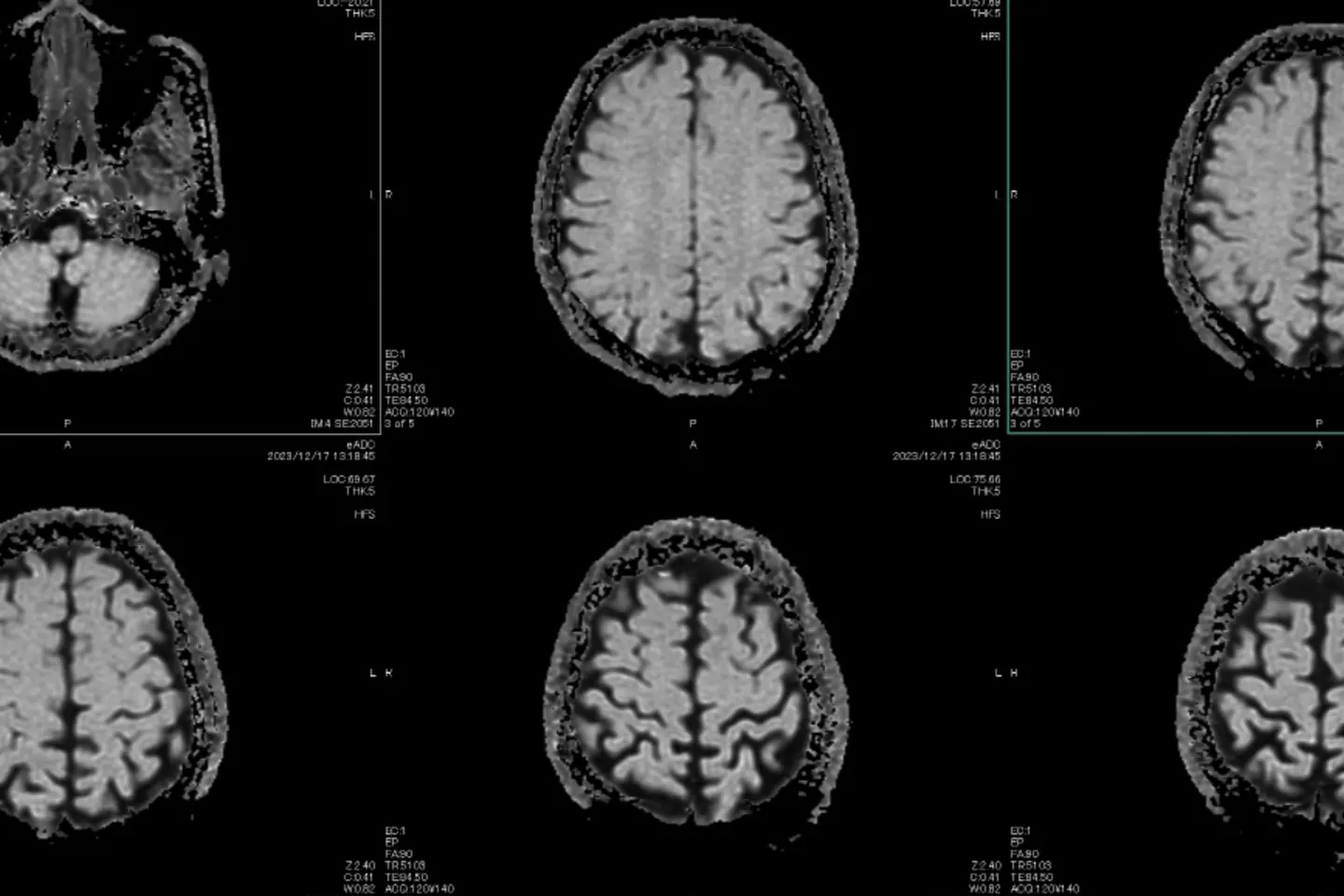 Mit Scan Brain Healthcare Is AI’s Hardest Test