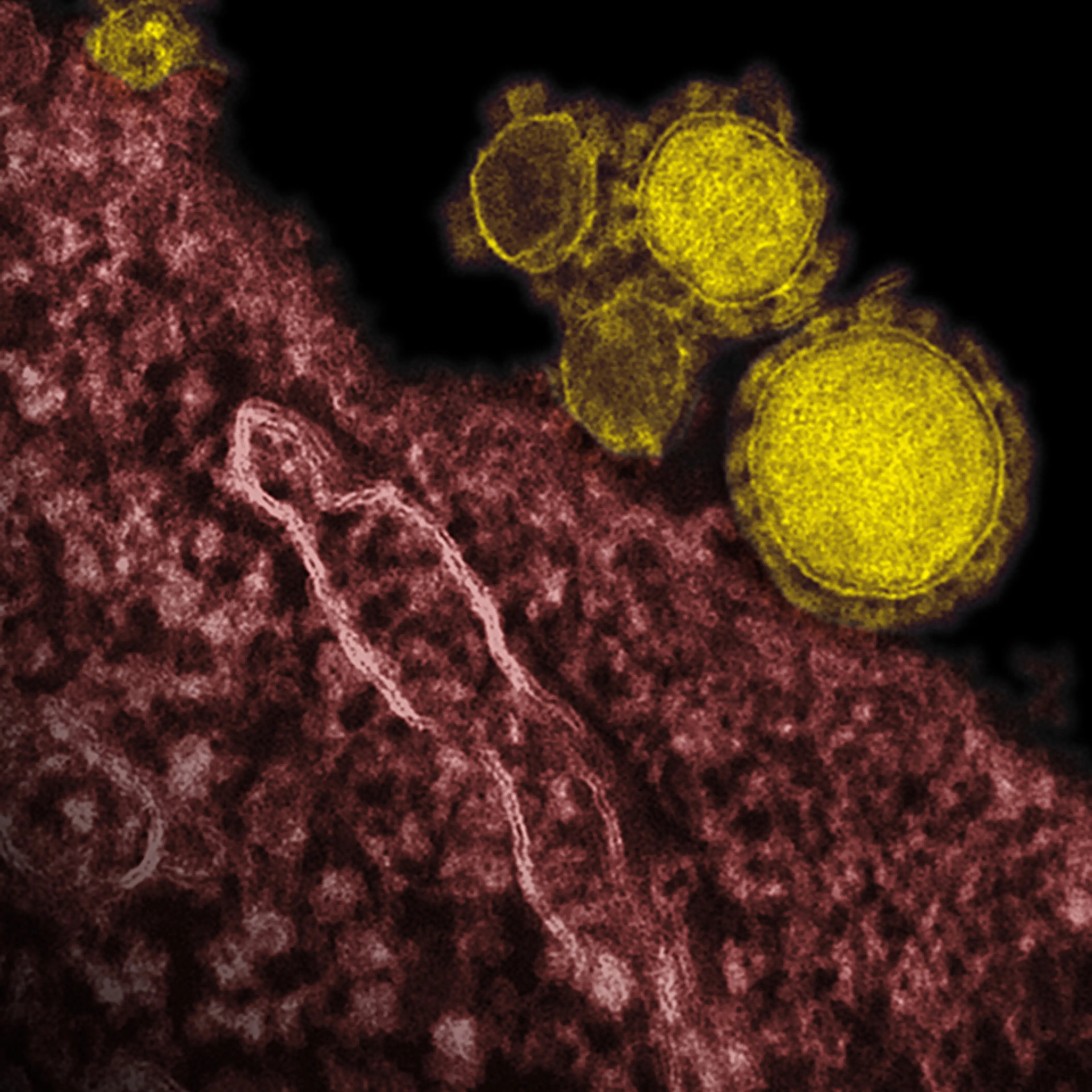 This undated file electron microscope image made available by the National Institute of Allergy and Infectious Diseases - Rocky Mountain Laboratories shows novel coronavirus particles, also known as the MERS virus, colorized in yellow.
