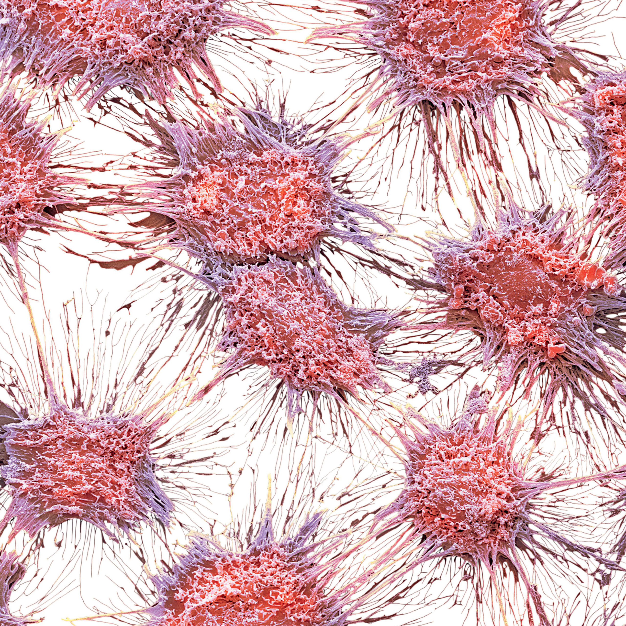 <b>Vaginal cancer cells</b> (colored scanning electron micrograph)