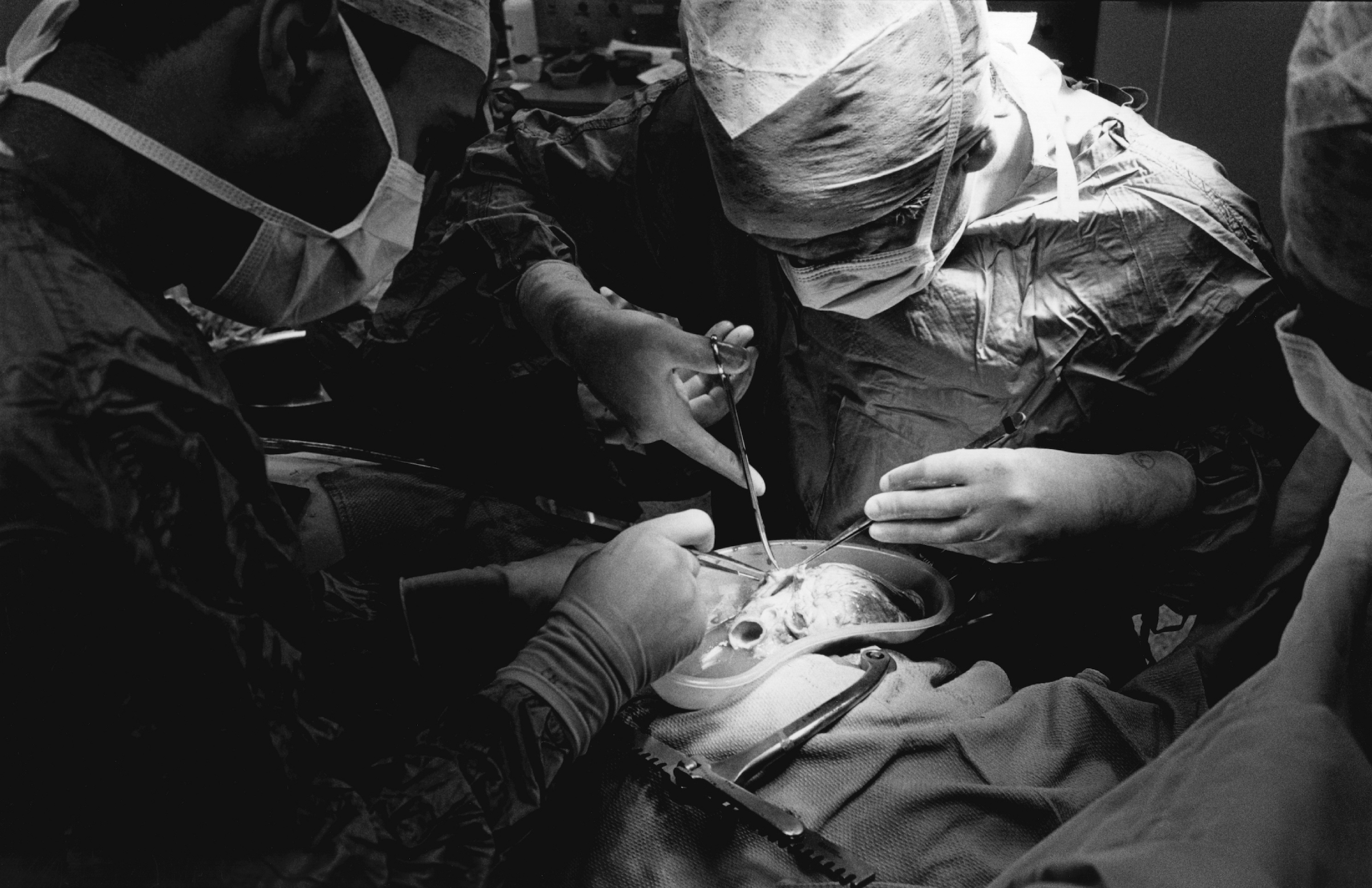 Heart Transplant Operation