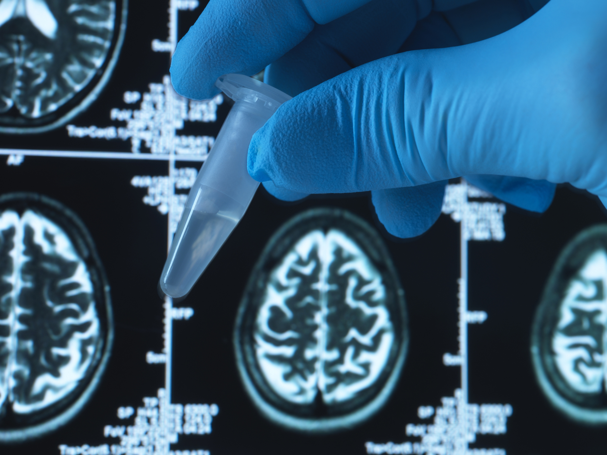 Pharmaceutical research into brain disorders including dementia and alzheimer's, eppendorf tube