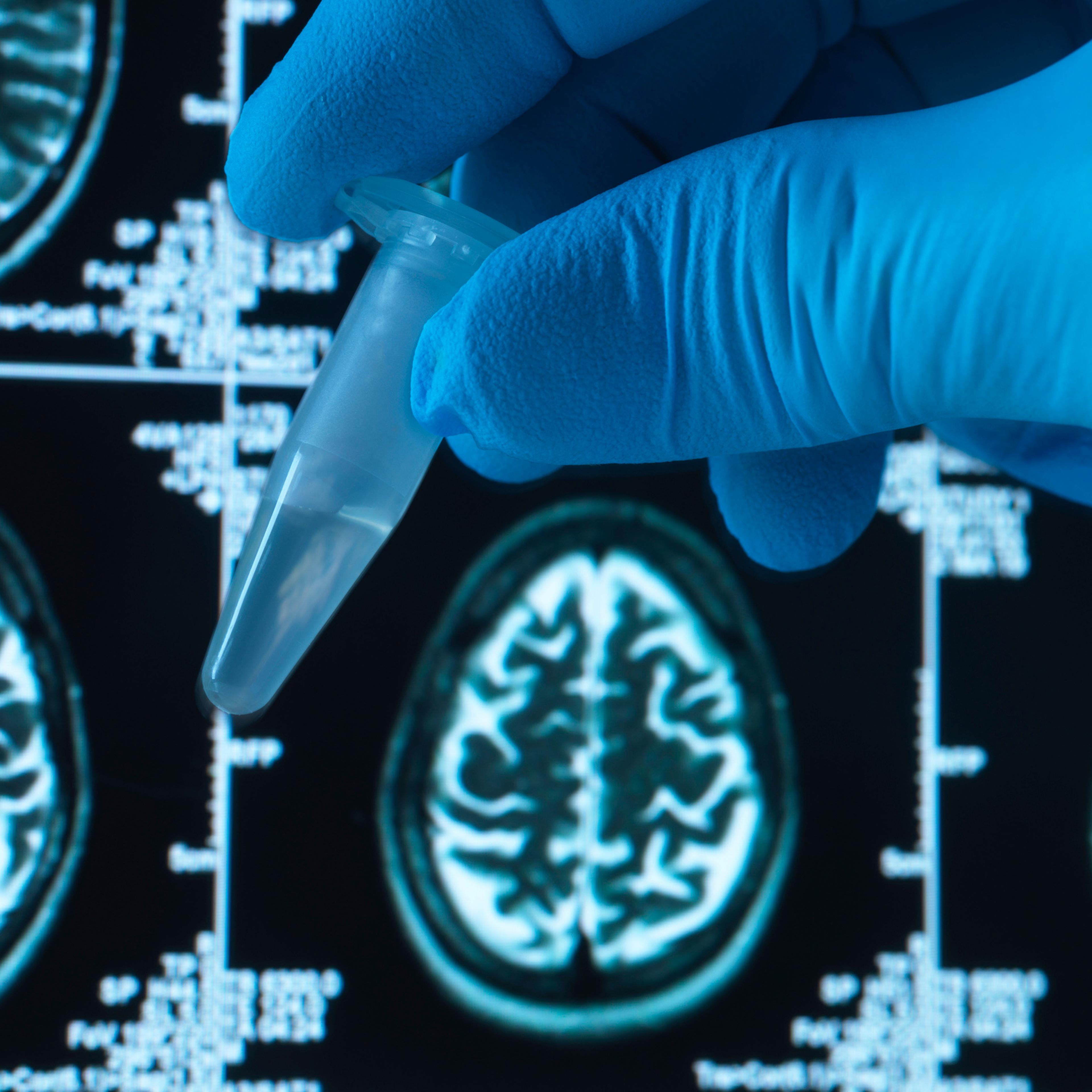 Pharmaceutical research into brain disorders including dementia and alzheimer's, eppendorf tube