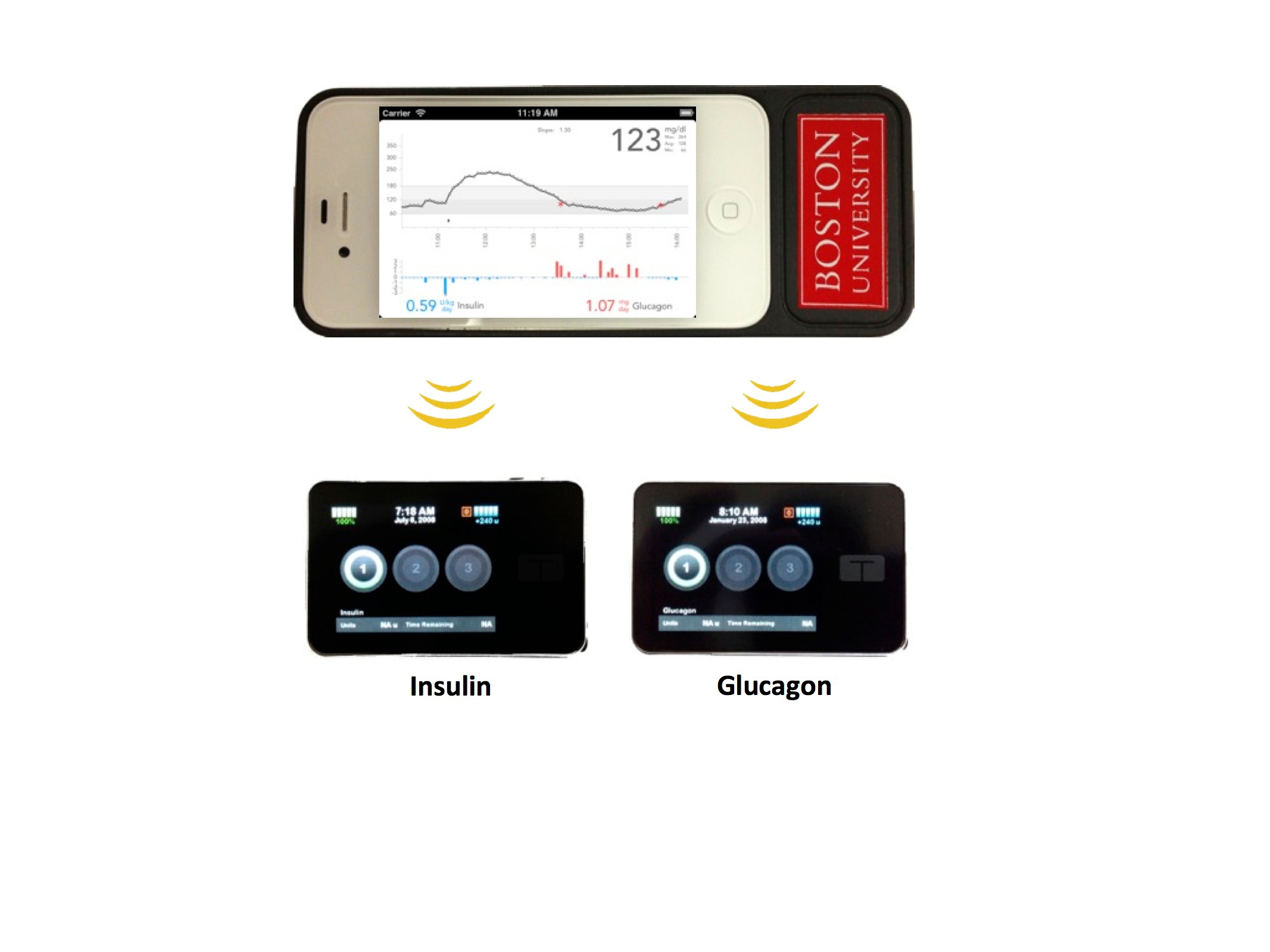 The bionic pancreas consists of a smartphone, top, hardwired to a continuous glucose monitor and two pumps, bottom, that pumps deliver doses of insulin or glucagon every five minutes.