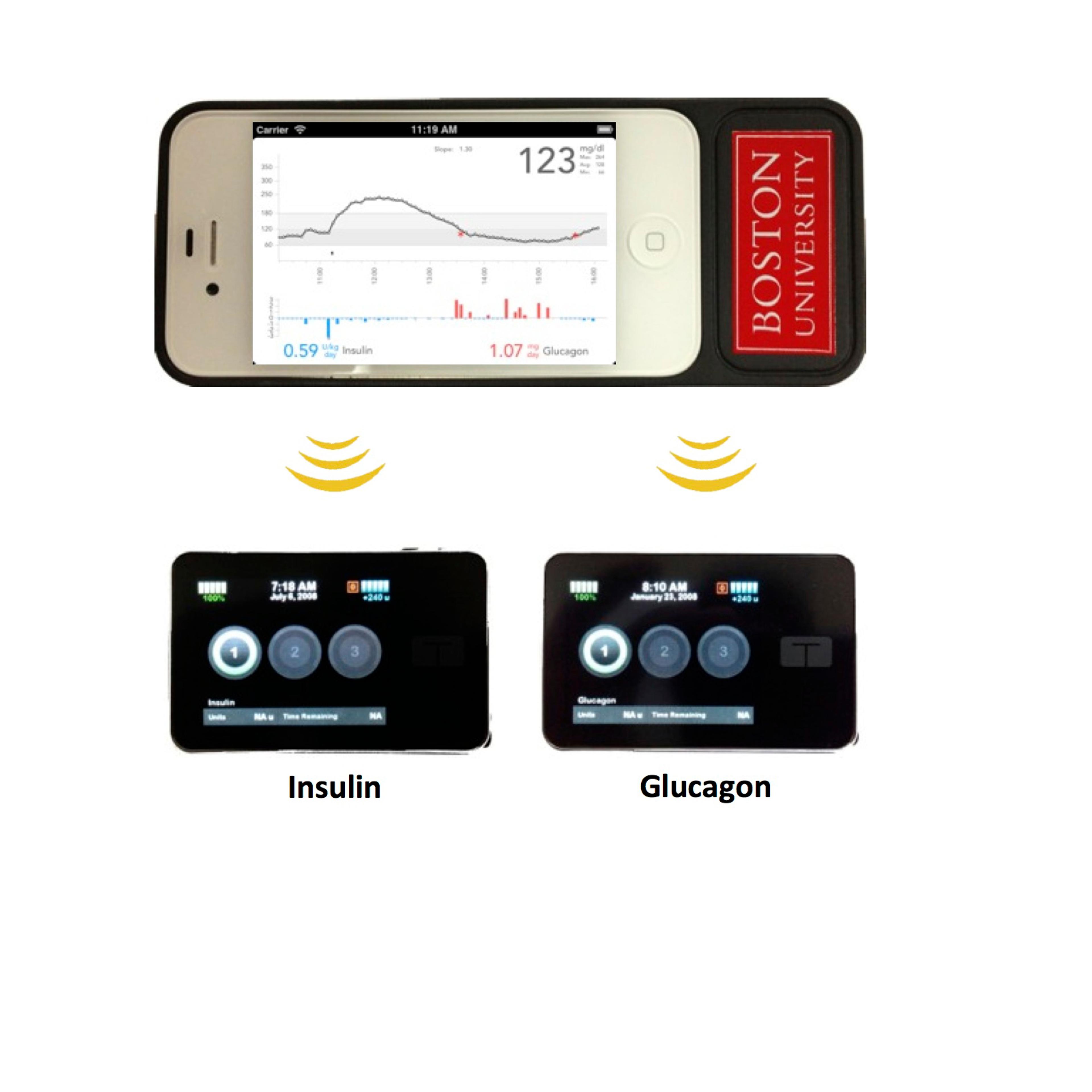 The bionic pancreas consists of a smartphone, top, hardwired to a continuous glucose monitor and two pumps, bottom, that pumps deliver doses of insulin or glucagon every five minutes.