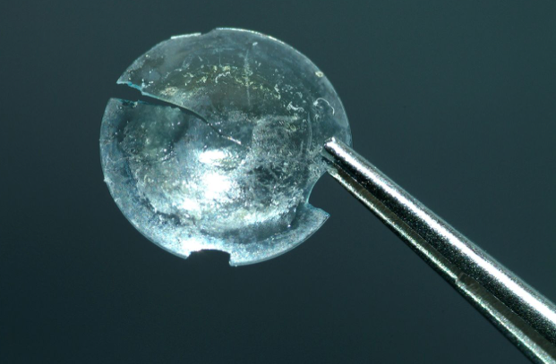 JULY 2018 - A 28 year-old contact lens was extracted from a woman's eyelid when she complained to doctors of swelling