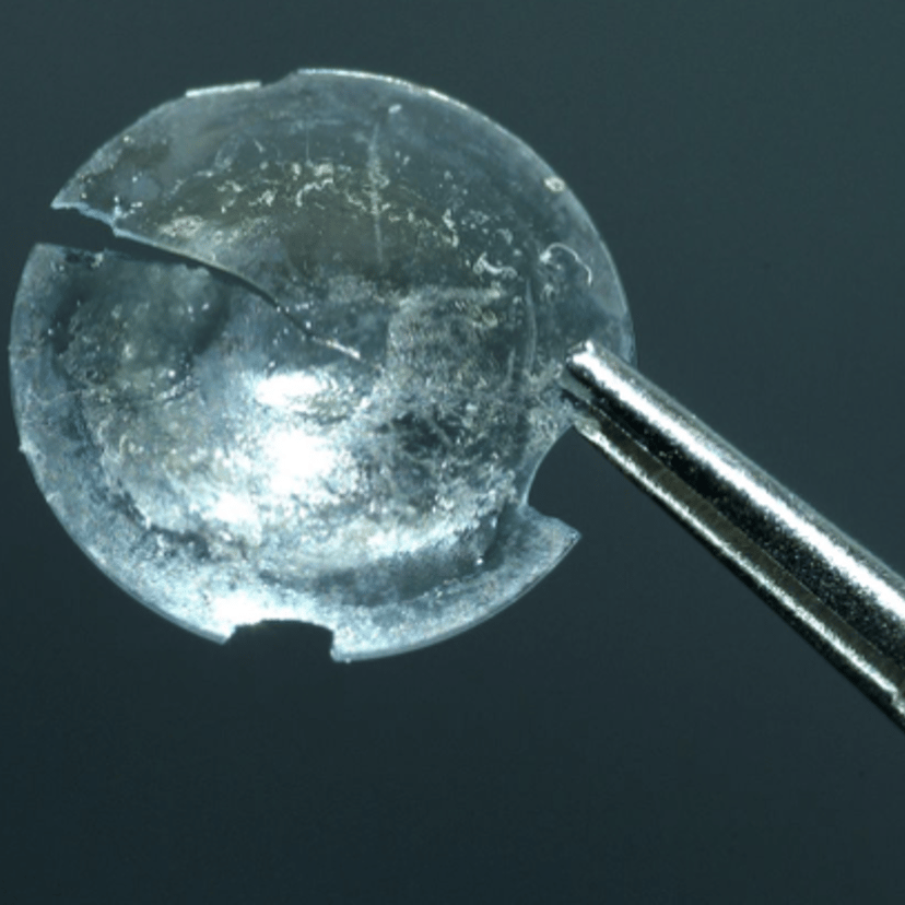 JULY 2018 - A 28 year-old contact lens was extracted from a woman's eyelid when she complained to doctors of swelling
