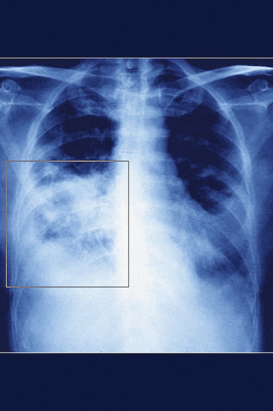 Pneumonia, Pneumocystis Carinii