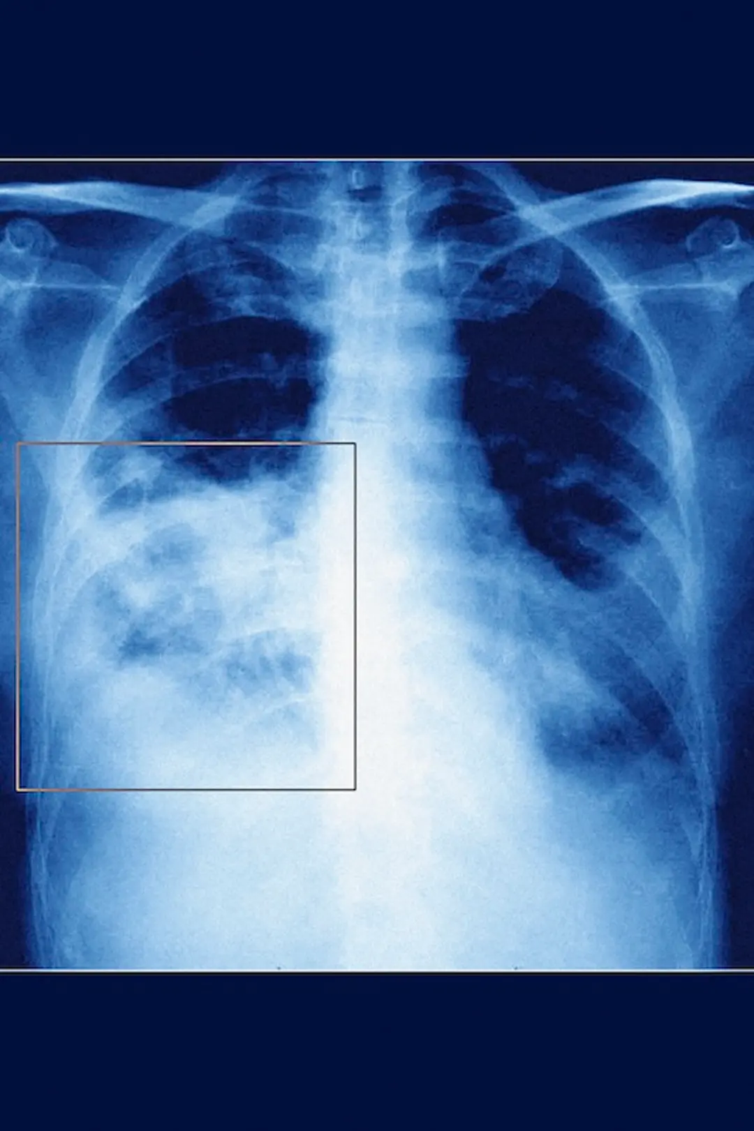 Pneumonia, Pneumocystis Carinii