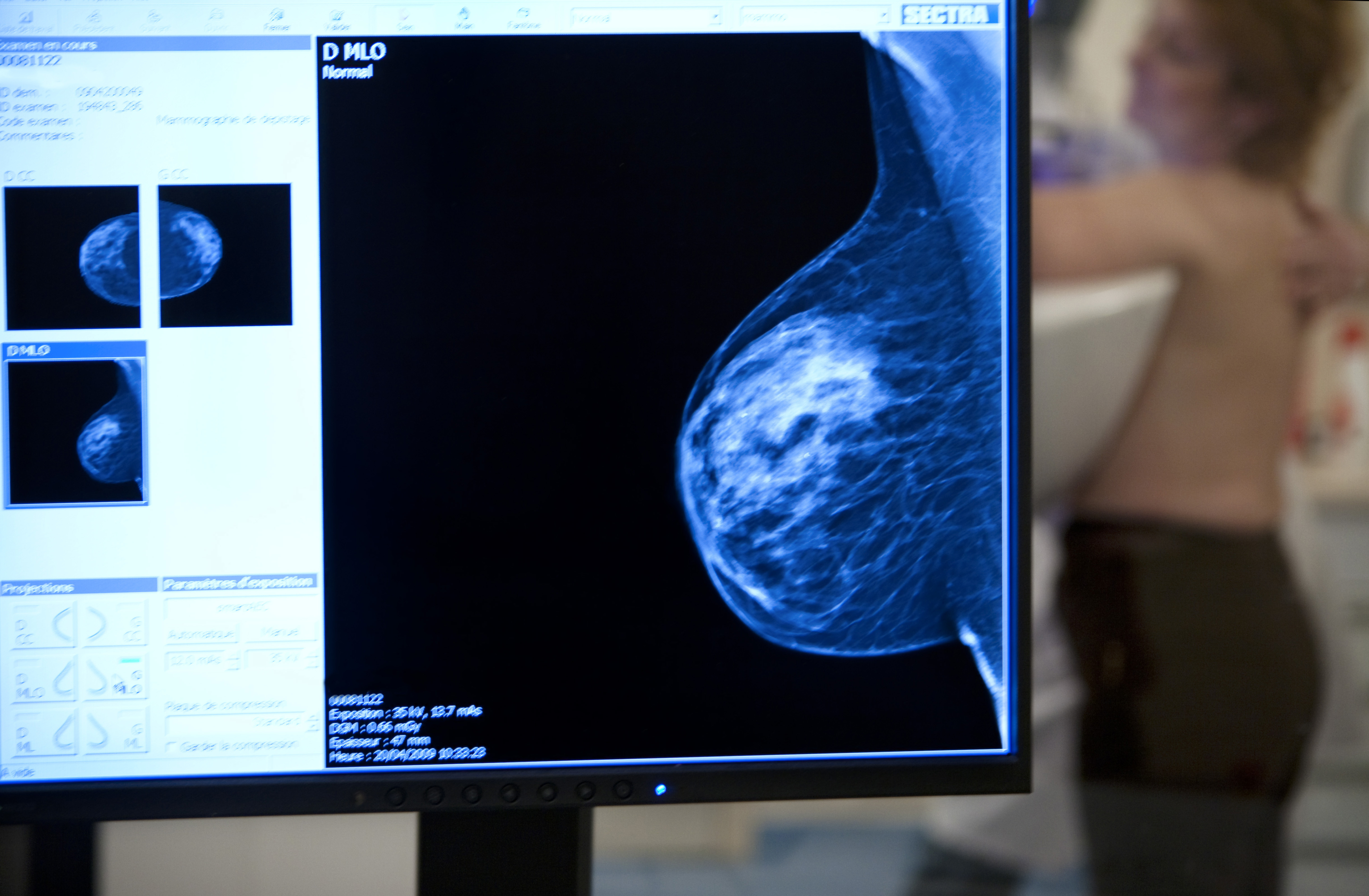 Mammography Examination