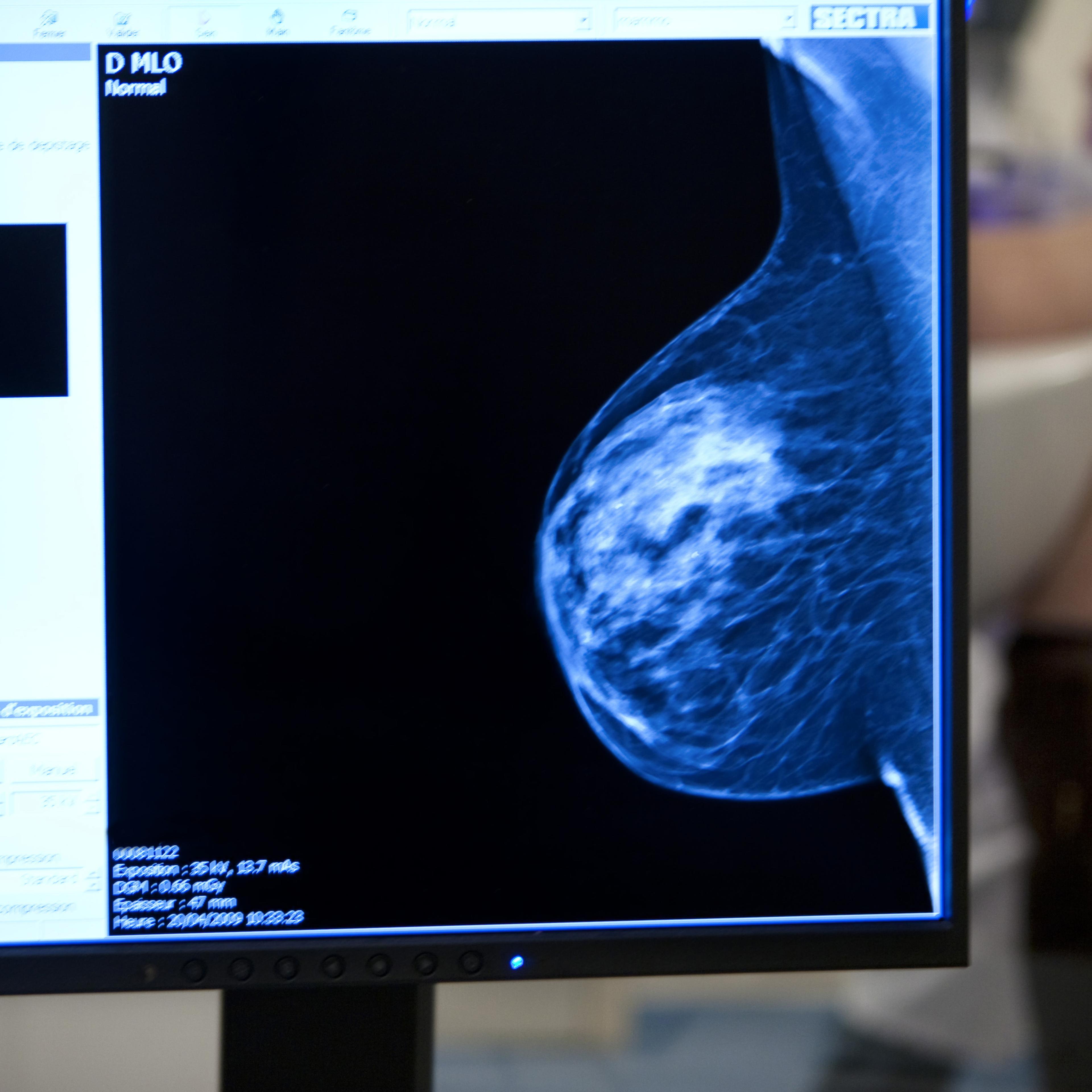 Mammography Examination