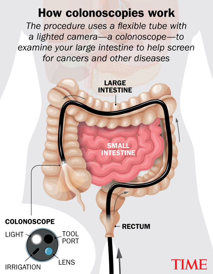 What to Expect at a Colonoscopy