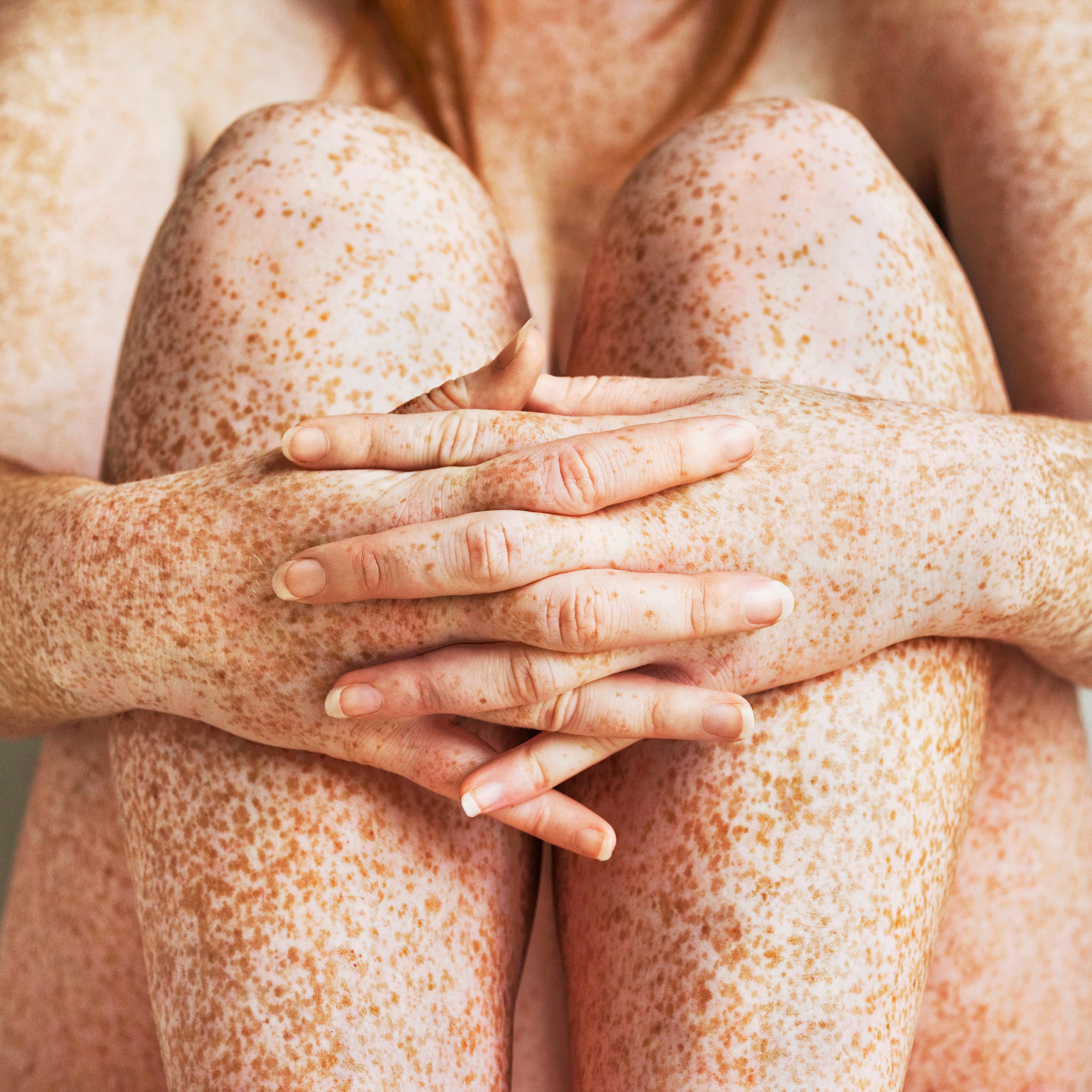 Freckled girls hands, arms and legs, close up TIME health stock