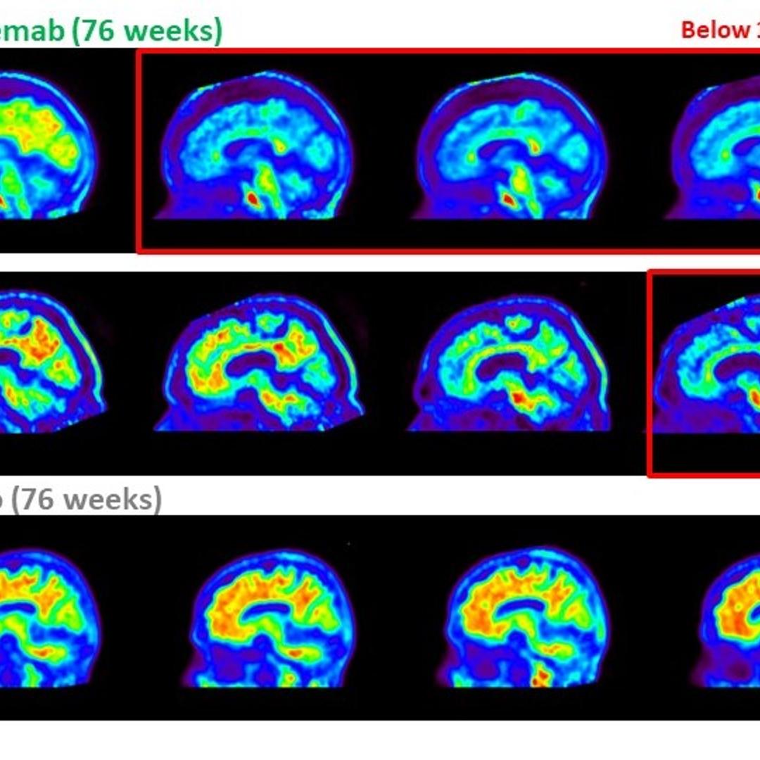 Brain scans show clearance of amyloid plaques, shown in red, in two patients, A and B, who received donanemab, compared to higher levels of amyloid in a patient who received placebo (bottom) in Eli Lilly's trial.