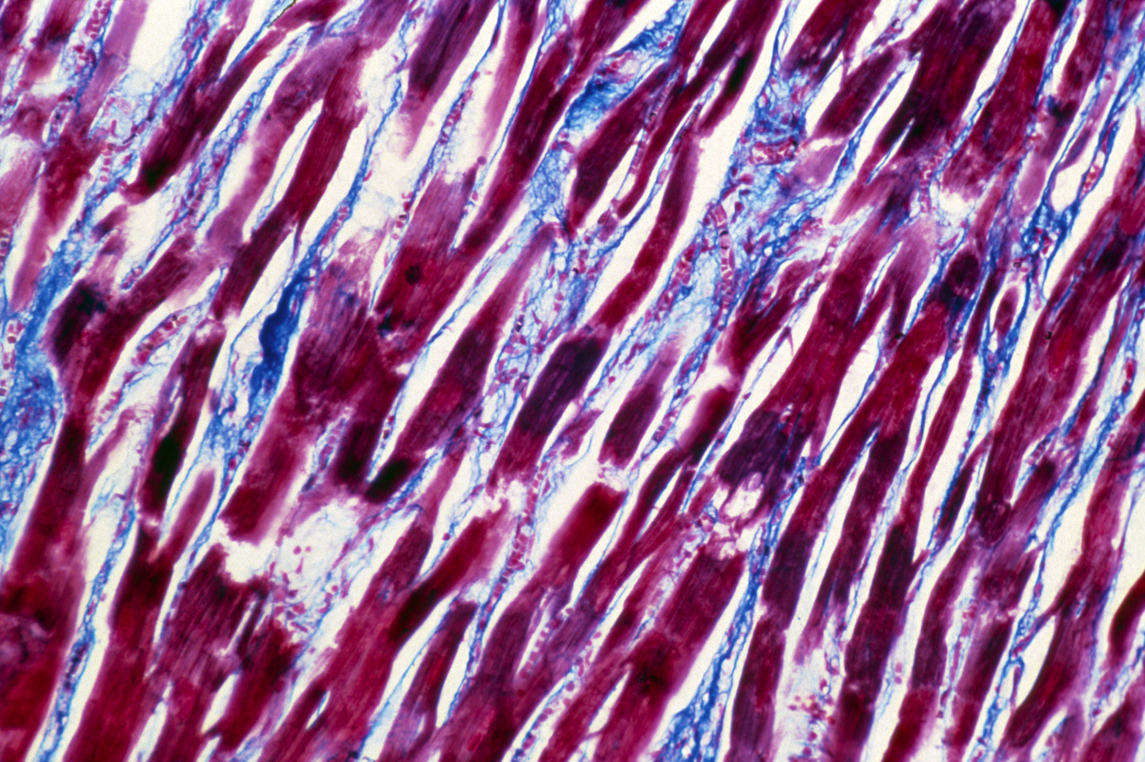 M of inflamed cardiac muscle (myocarditis)