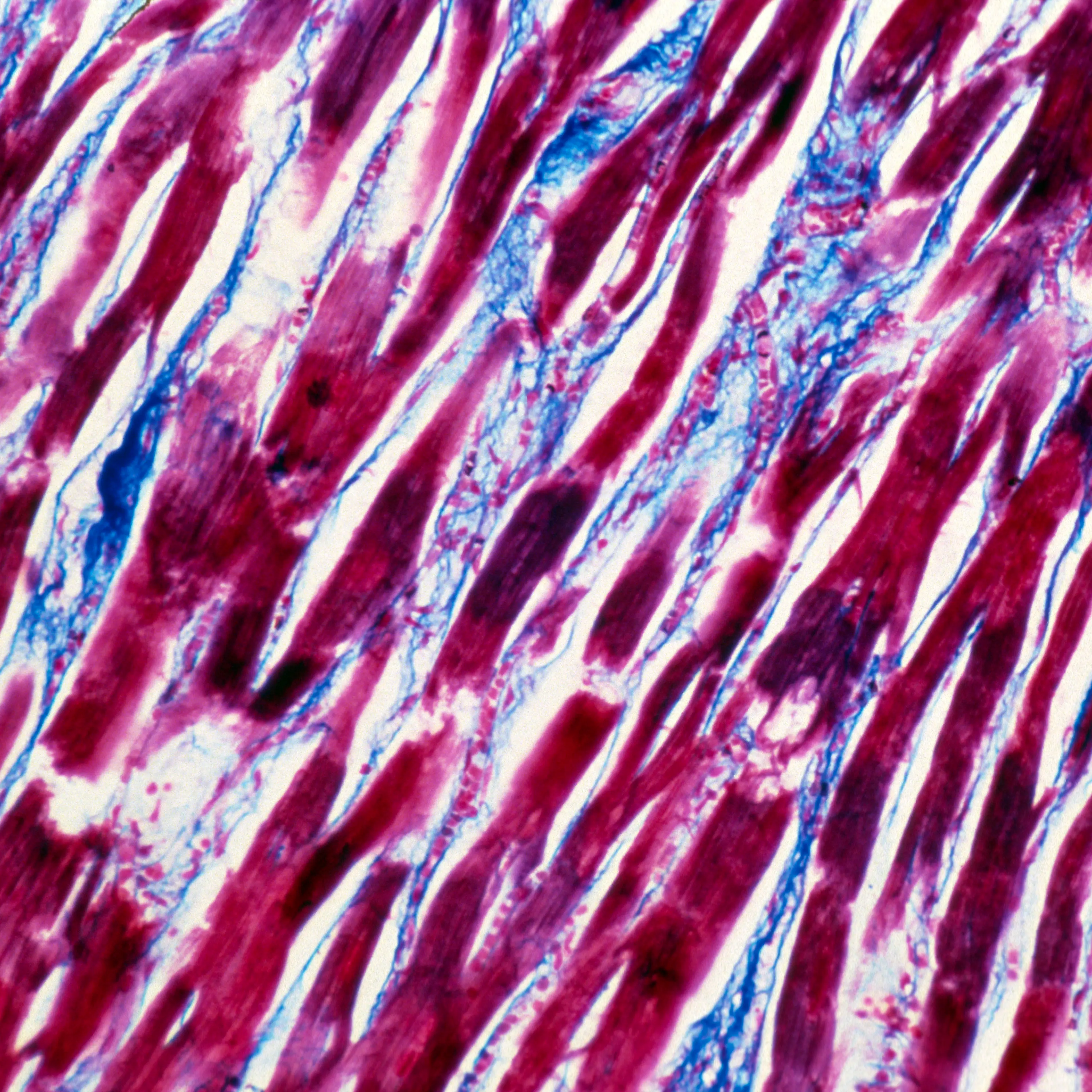 M of inflamed cardiac muscle (myocarditis)