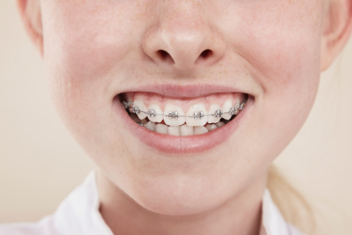 girl-braces-smile