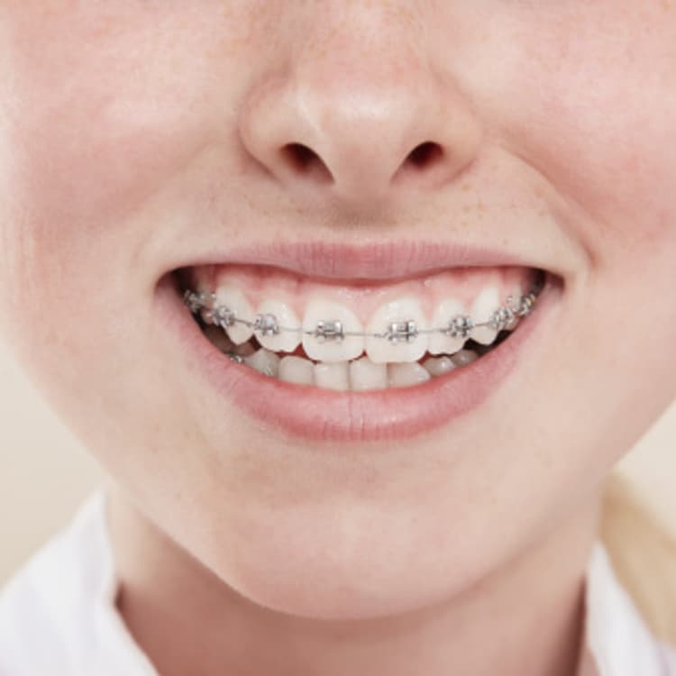 girl-braces-smile